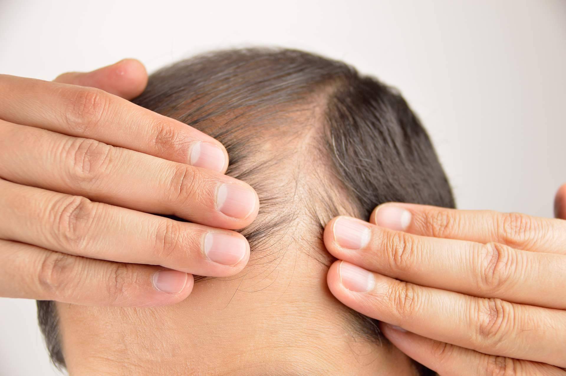 ¿Dónde realizarse un trasplante de cabello con la técnica Zafiro FUE en Benidorm, Elche y Villena y Madrid? Élite Capilar