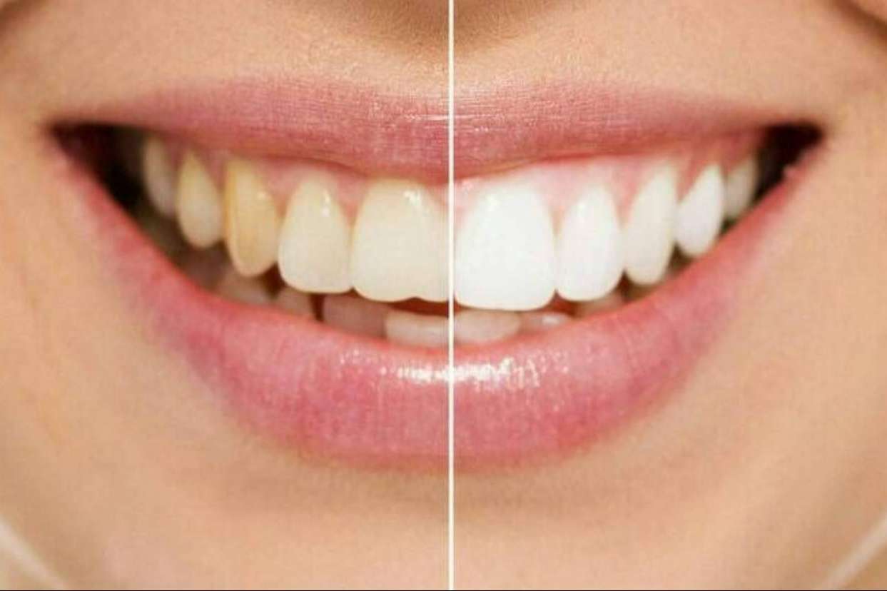 Para conseguir una sonrisa perfecta, ¿son mejores las carillas o el blanqueamiento?