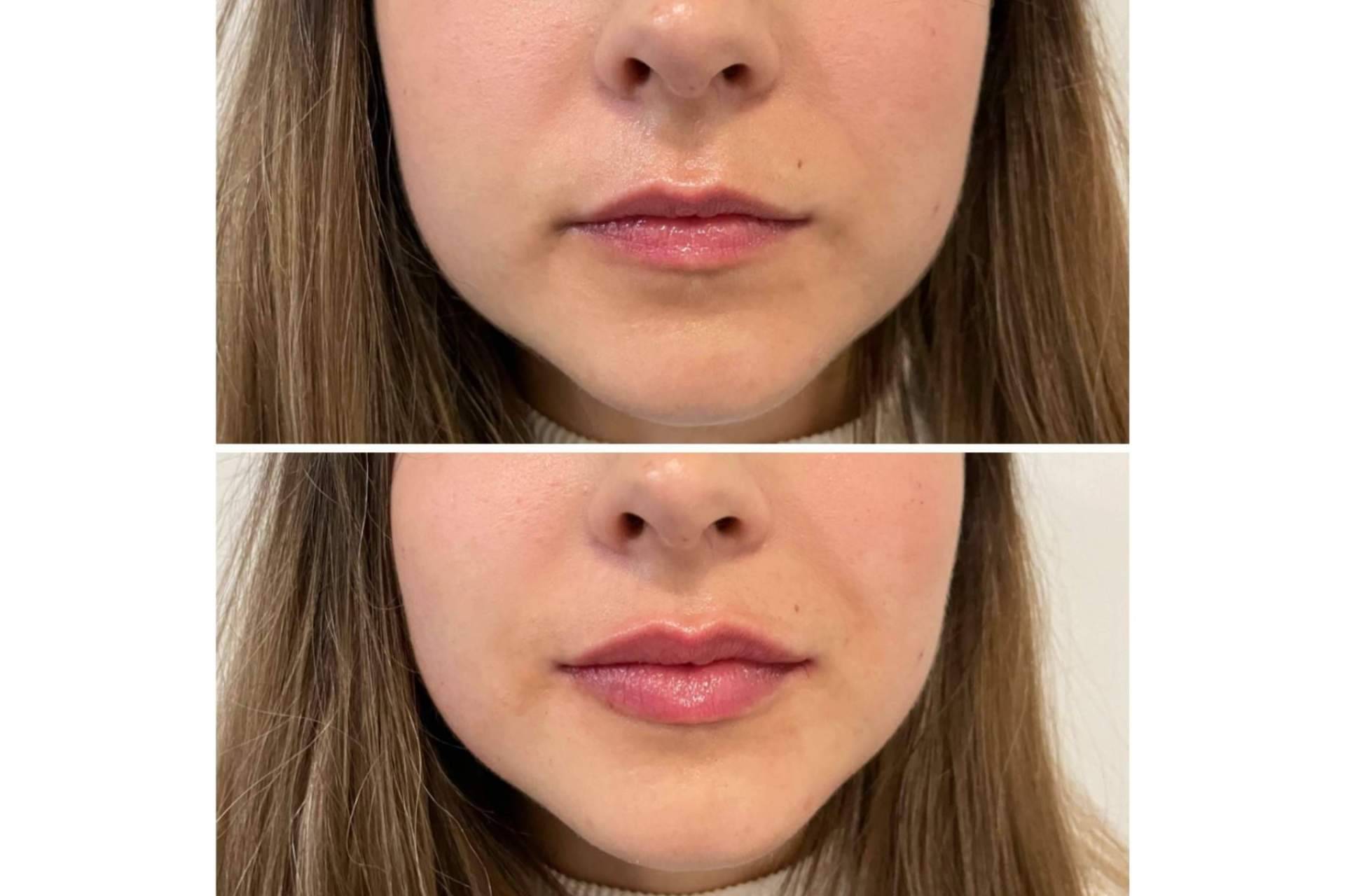 ¿Es posible realizarse un aumento de labios en Madrid con resultados naturales?, por la Dra. Cecilia Arthur