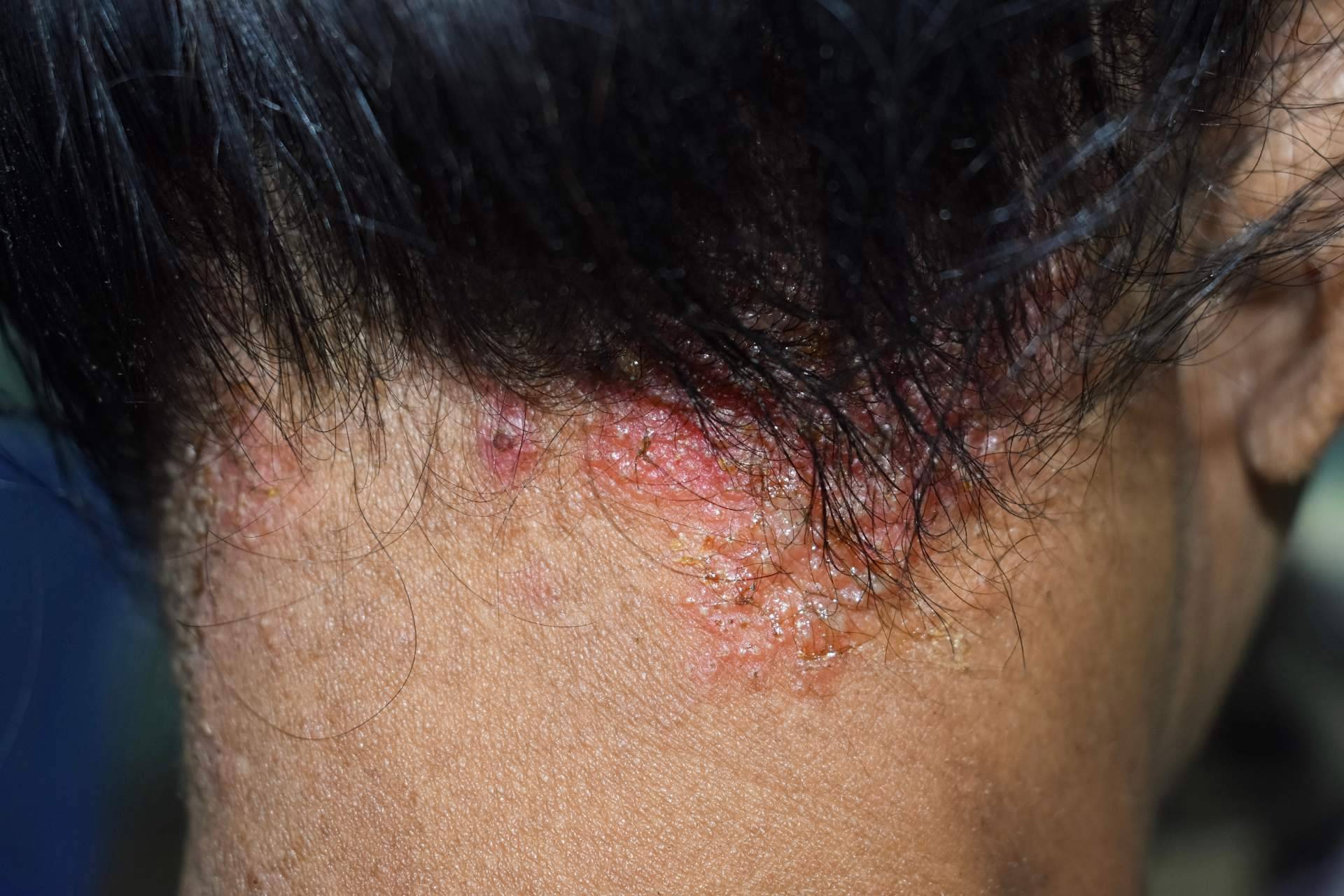 Dermatitis seborreica, una afección que puede provocar alopecia si no se trata
