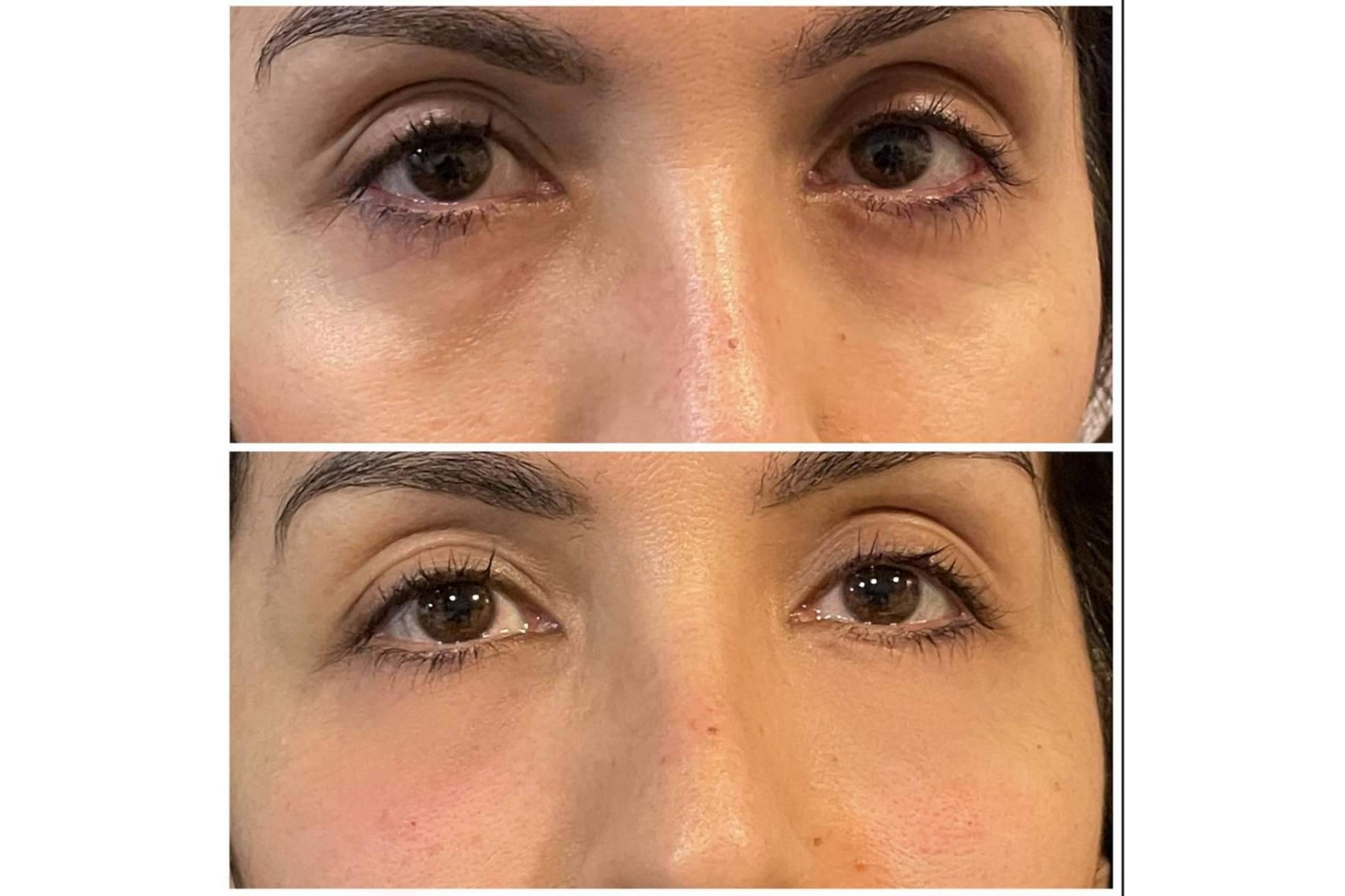 Despertar la mirada con el tratamiento de relleno de ojeras con ácido hialurónico de Cecilia Arthur