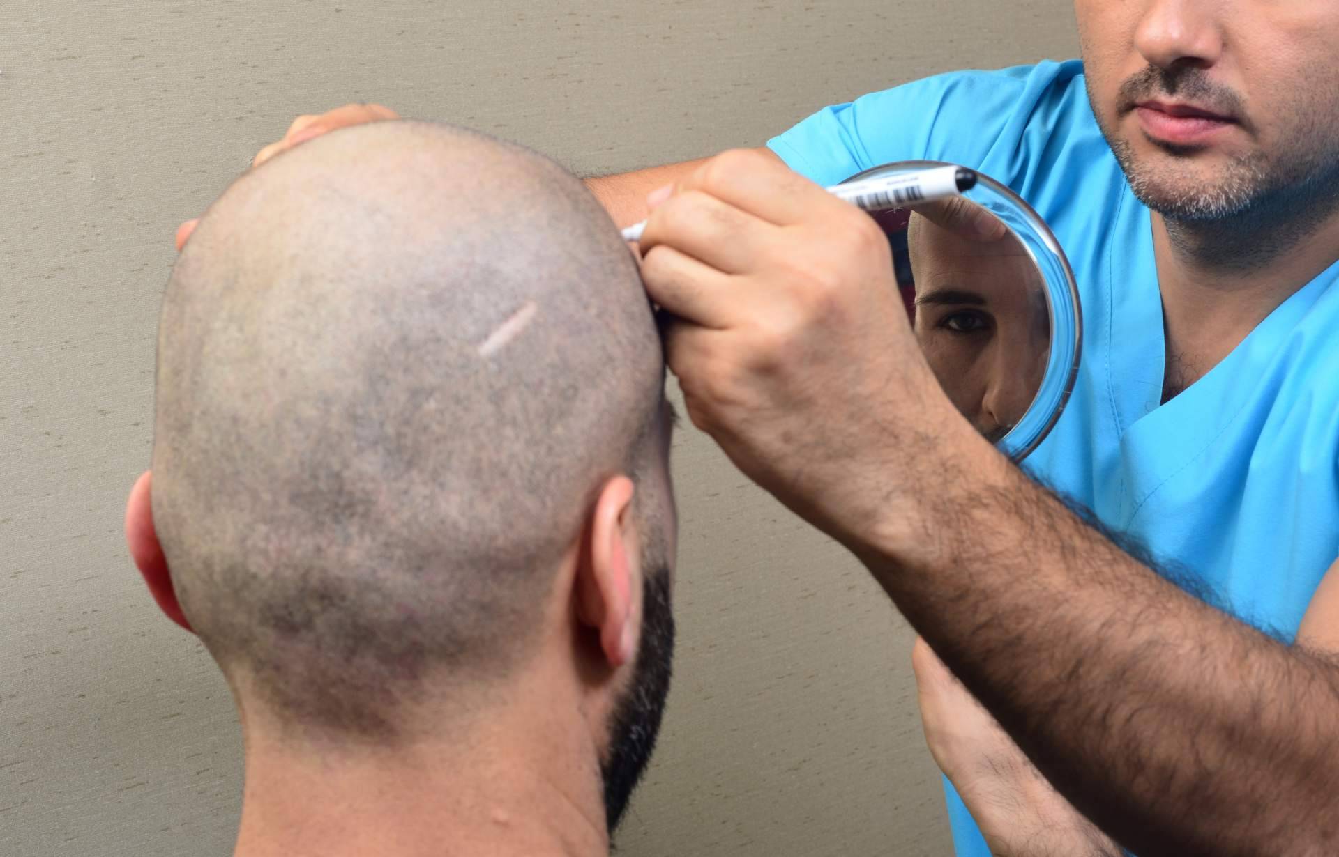 Implantes capilares con Clínicas Élite Capilar, destacados expertos en el sector