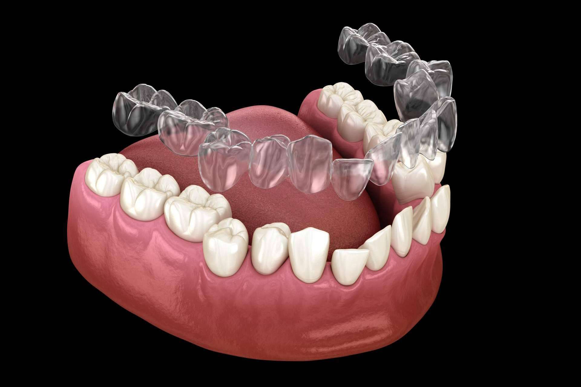 Ortodoncia invisible en Valencia, con los servicios de la Clínica Dental Bucalia