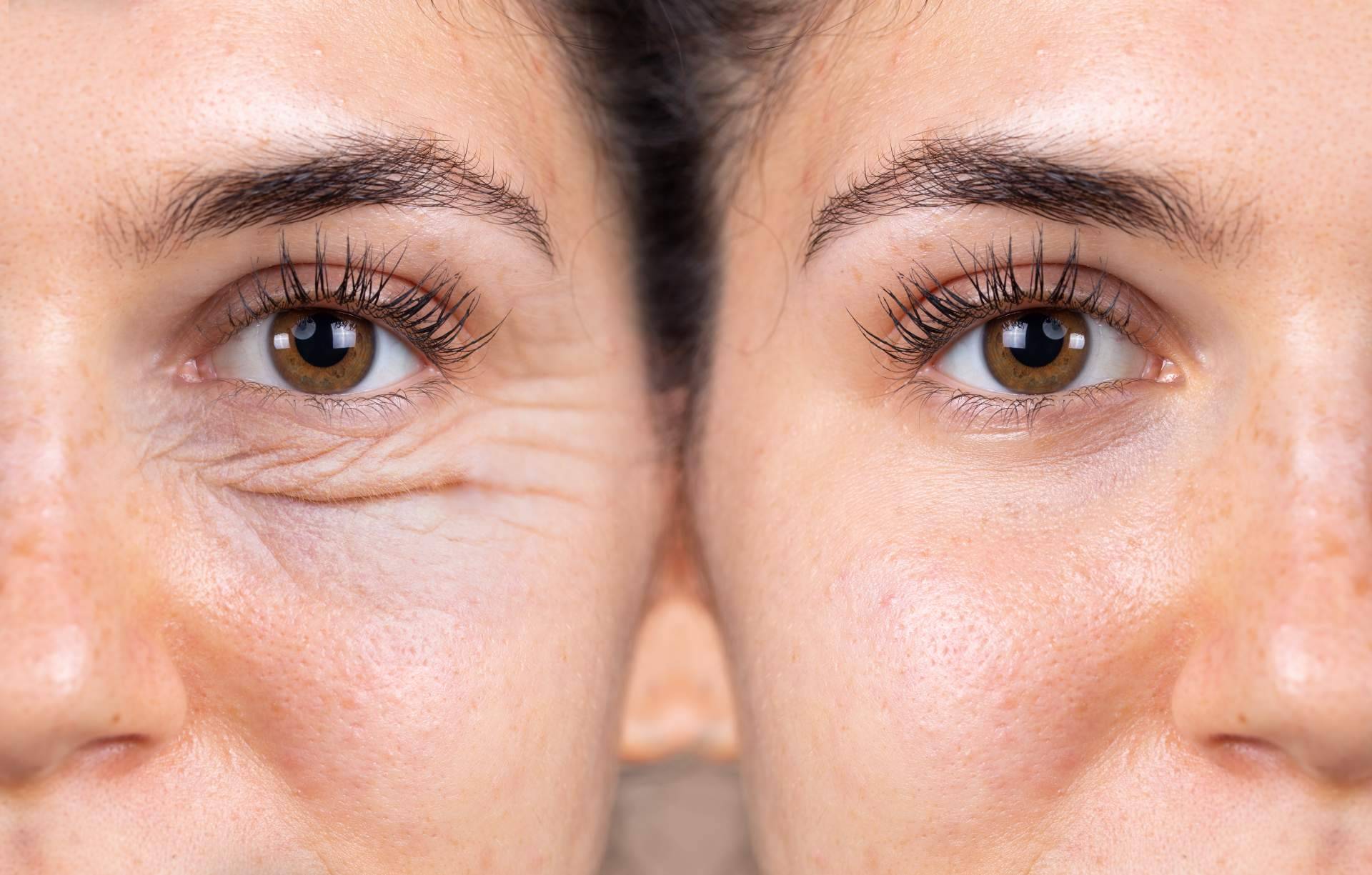 La blefaroplastia no quirúrgica de Alluring Clinic