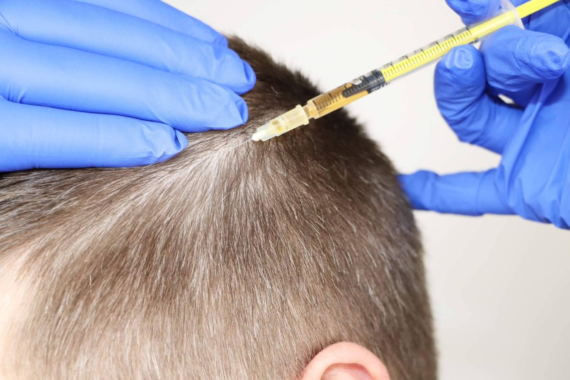 Los beneficios de la mesoterapia capilar Madrid de la mano de los profesionales de Crina Rus Beauty Center