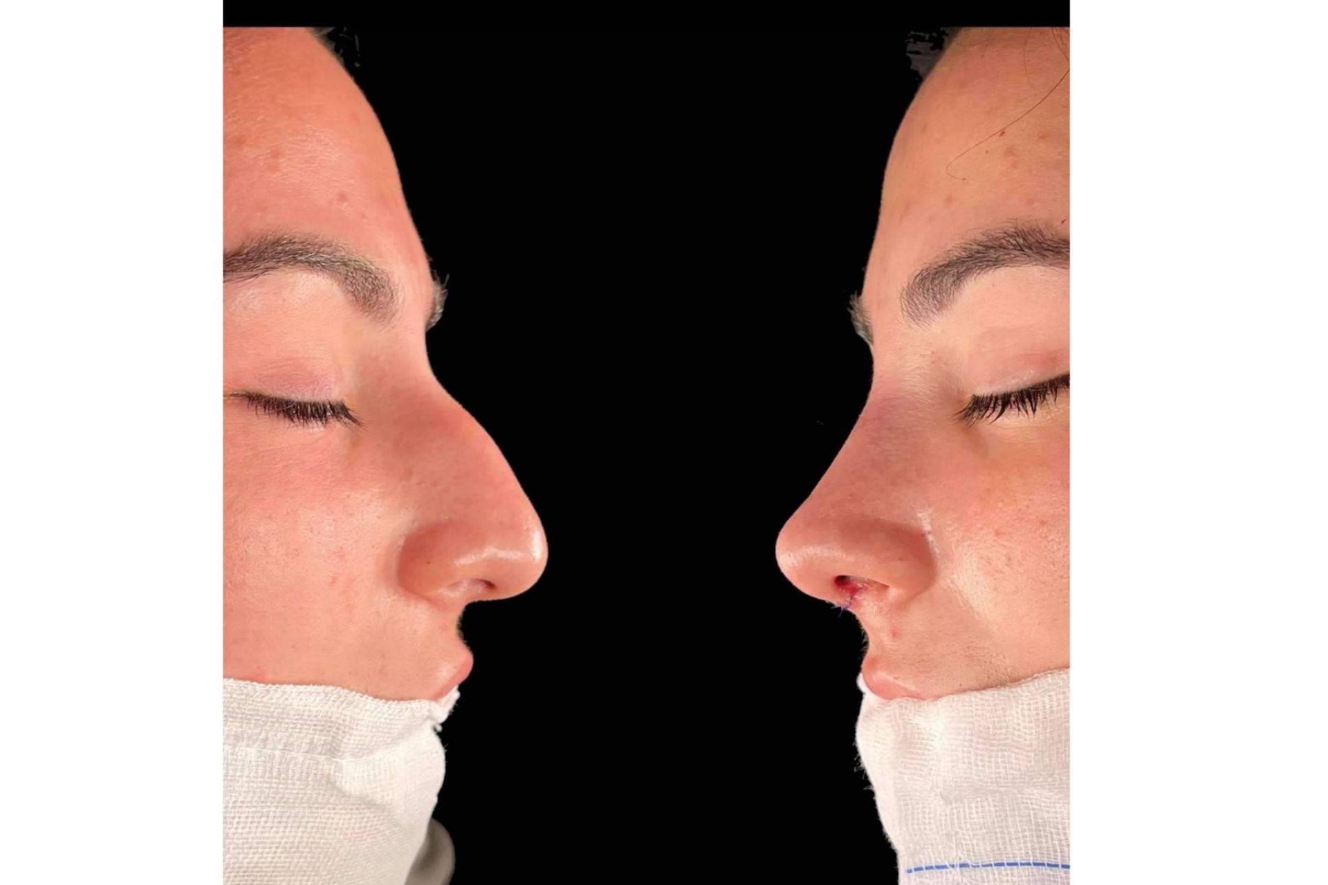 El Dr. Pérez Villar explica cómo recuperarse de una rinoplastia