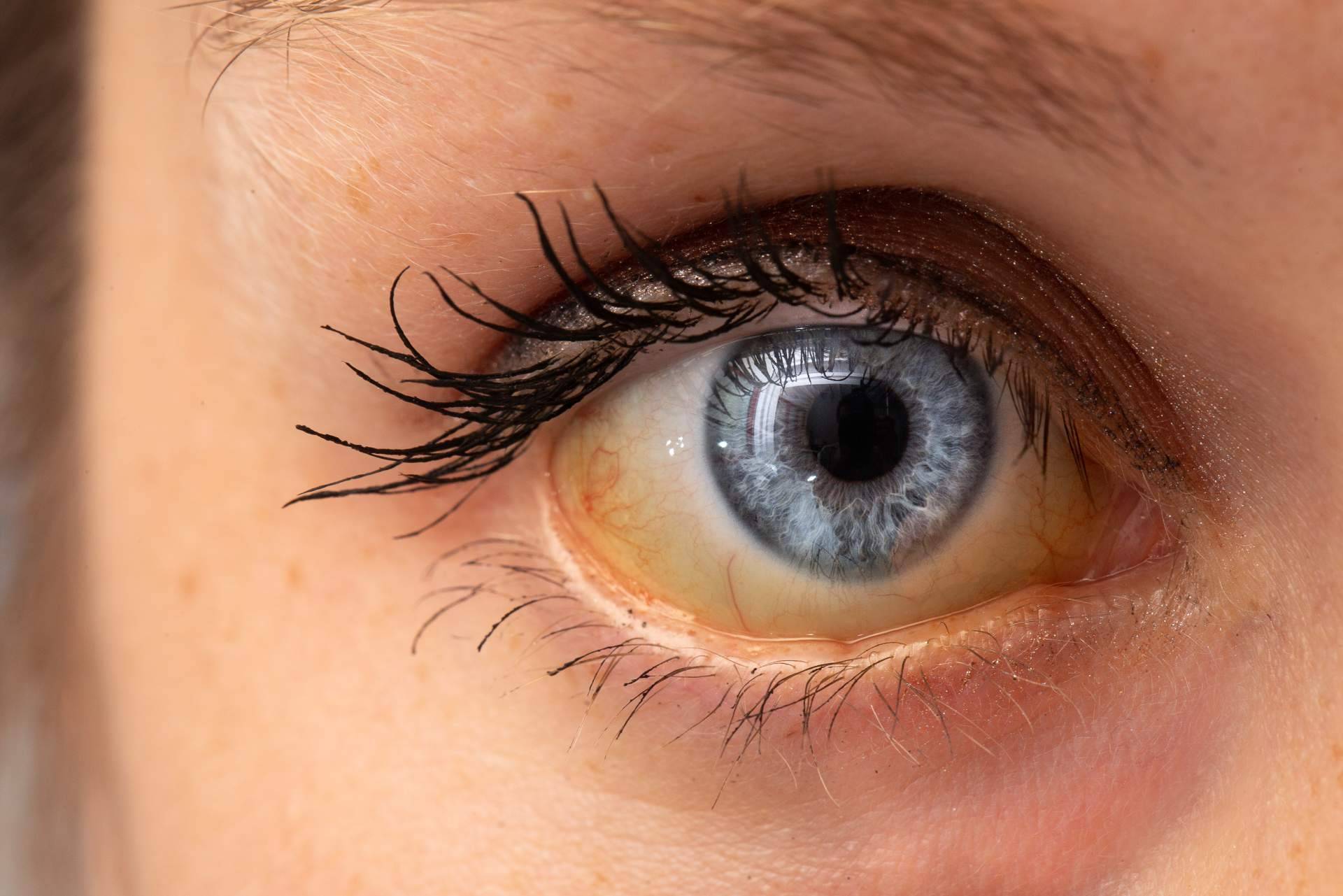 Las causas de los ojos amarillos y dónde tratarlos, explicado por el Instituto Oftalmológico Dexeus