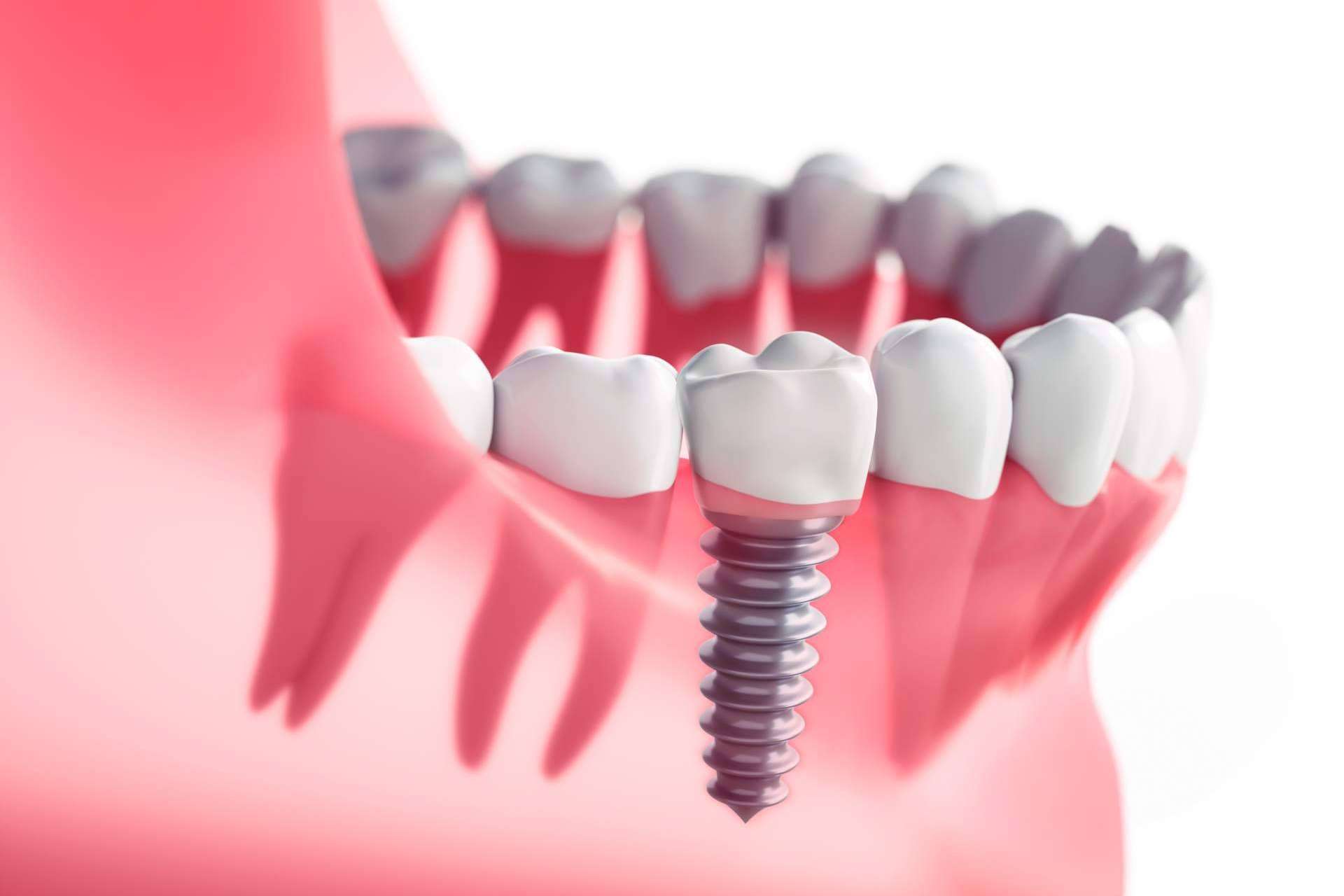 ¿Qué tipos de implantes dentales existen y cuáles se deben usar según cada caso?, por DeltaDent