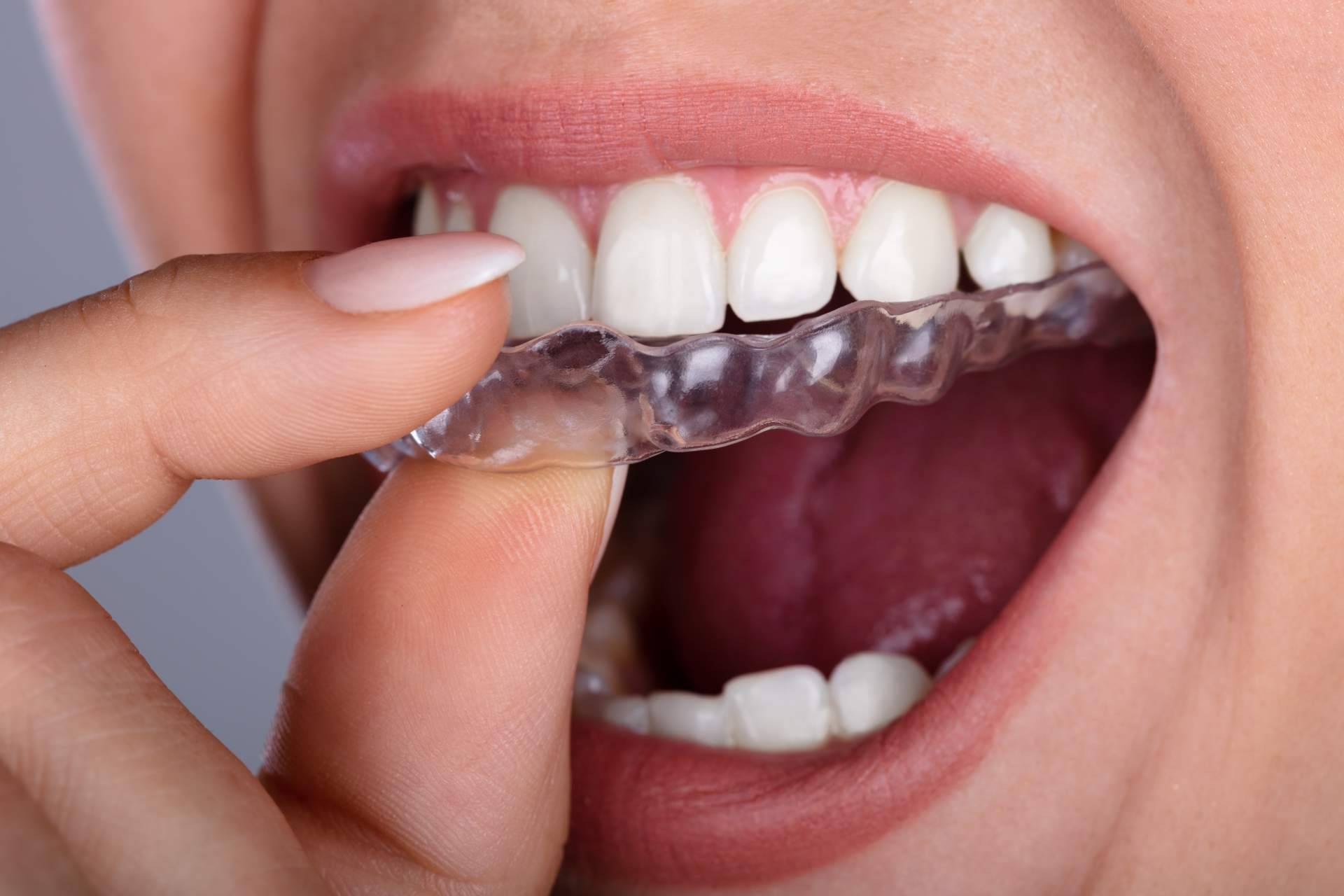Los implantes y el tratamiento de ortodoncia aplicados por DrMouth