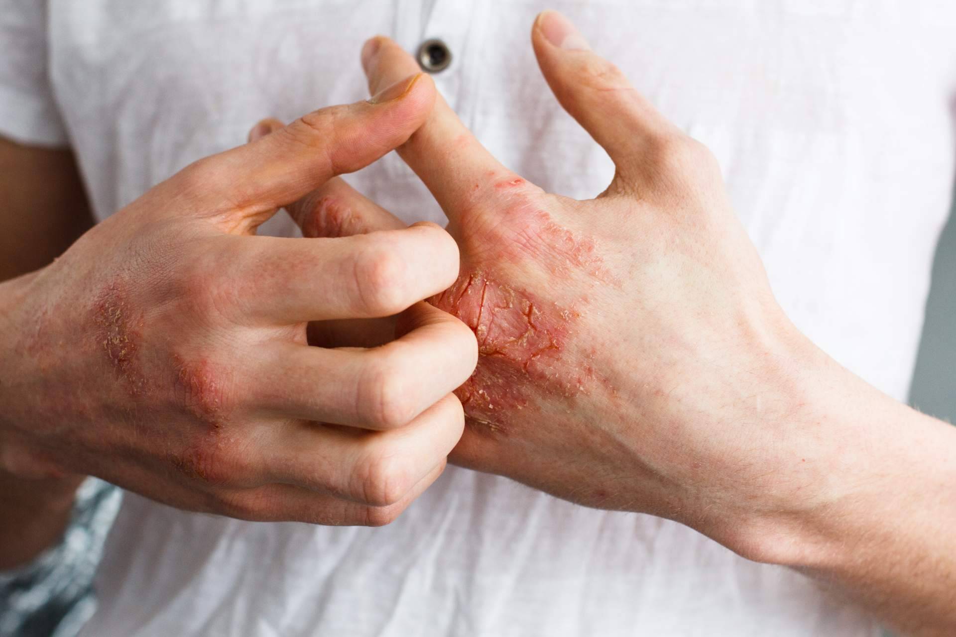 Tratamientos efectivos para la piel atópica en Green Cornerss Care