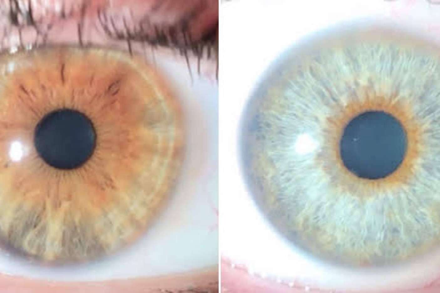 Los avances en las operaciones de cambio de color de ojos con láser, de la mano de Clínica Eyecos
