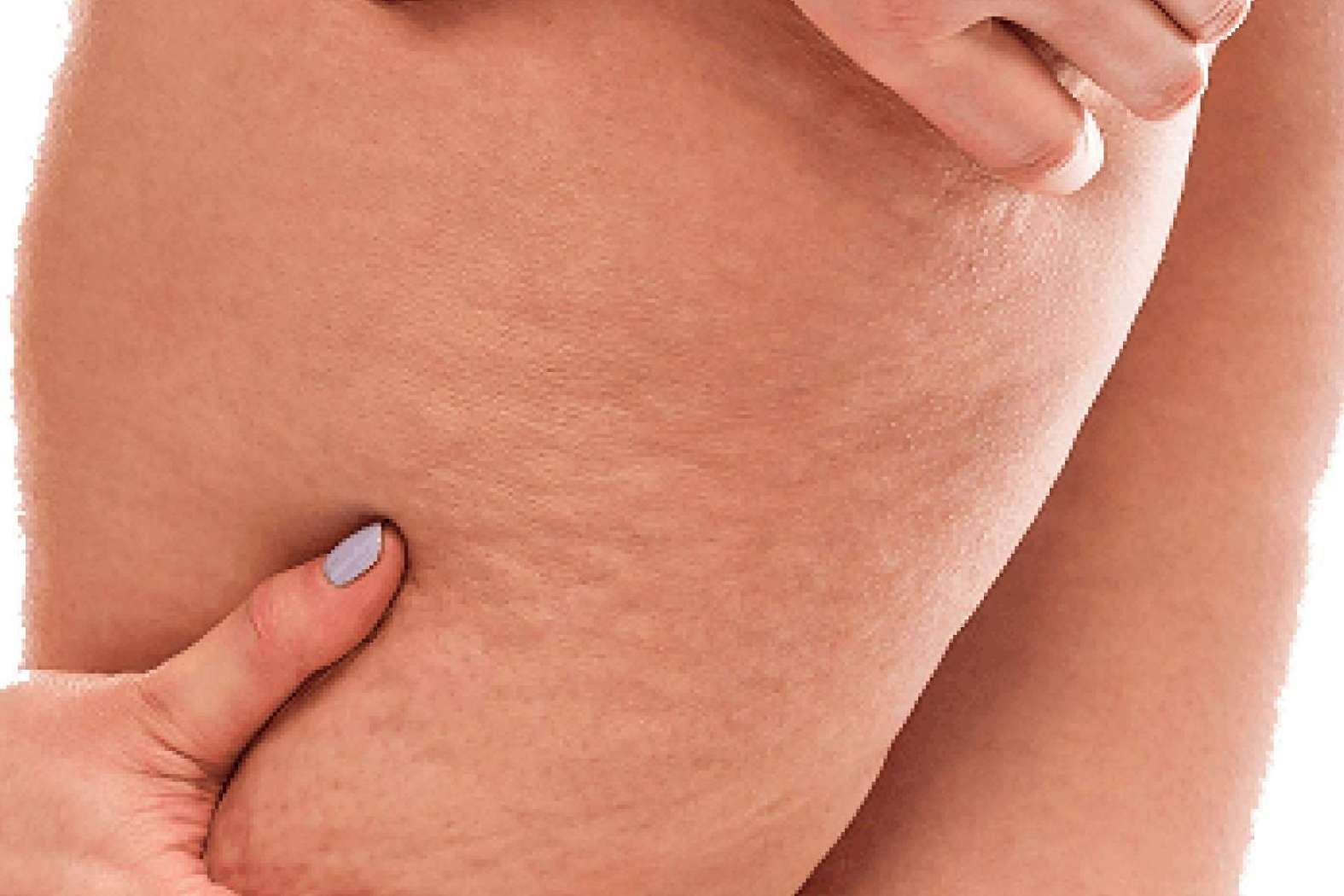Identificar el nivel de la celulitis para determinar los procesos y terapias acertadas, con los sensores especiales de Soluciones