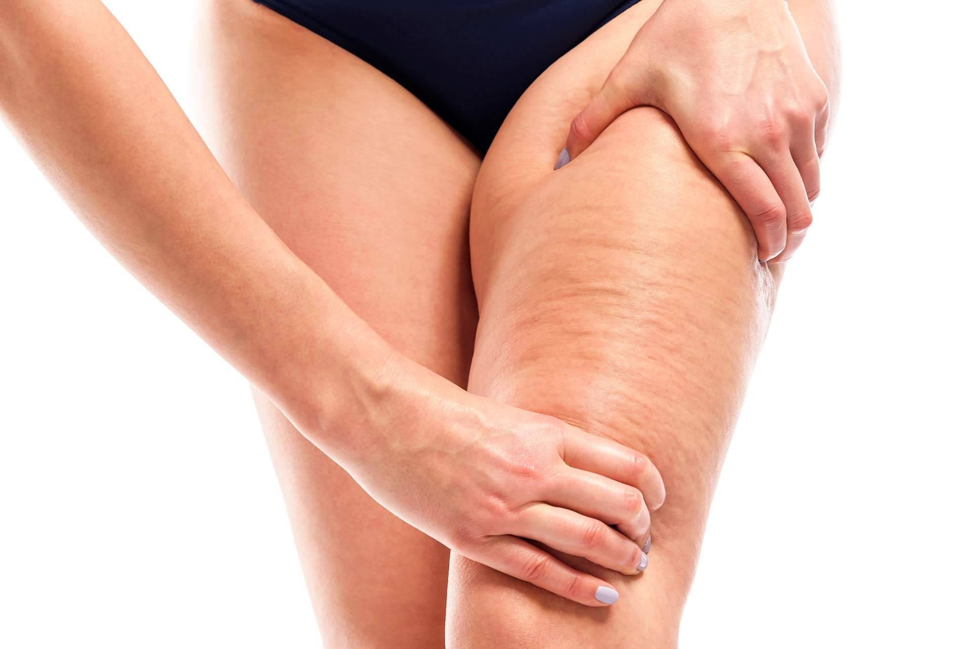 El tratamiento corporal para tratar y reducir la celulitis Vacuslim 48, ¿funciona realmente?