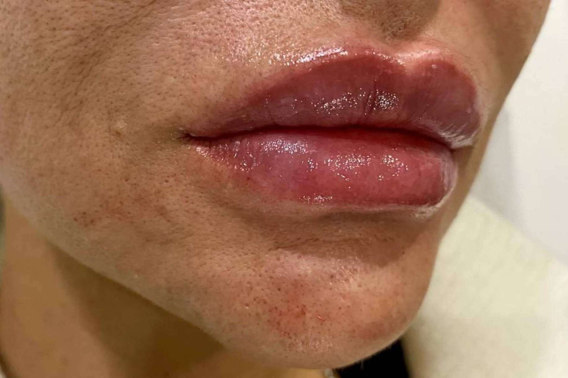 Remodelación y aumento de labios con rellenos de ácido hialurónico