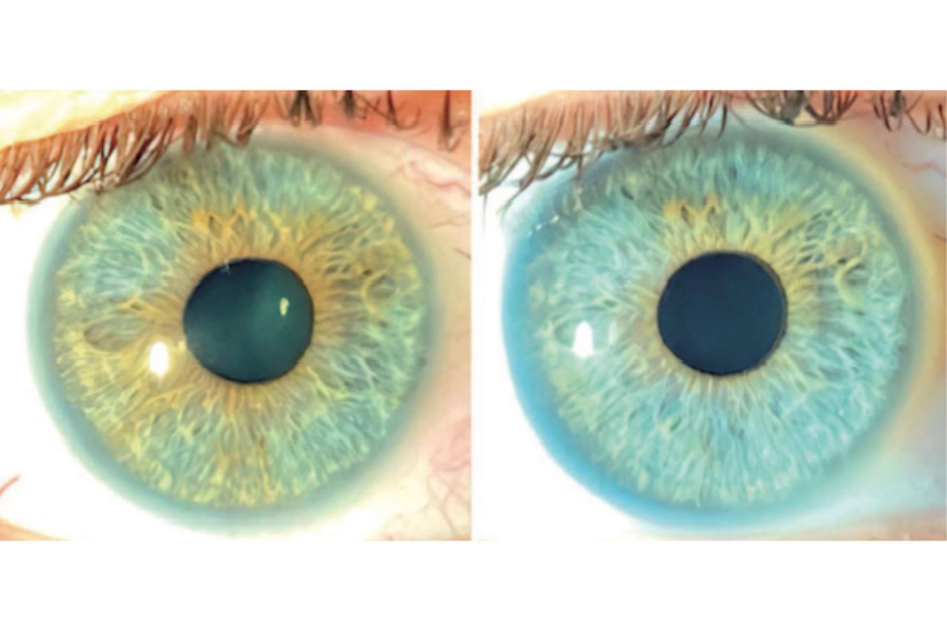 Los heterocromías y los nevus del iris pueden ser tratados con láser según Clínica Eyecos