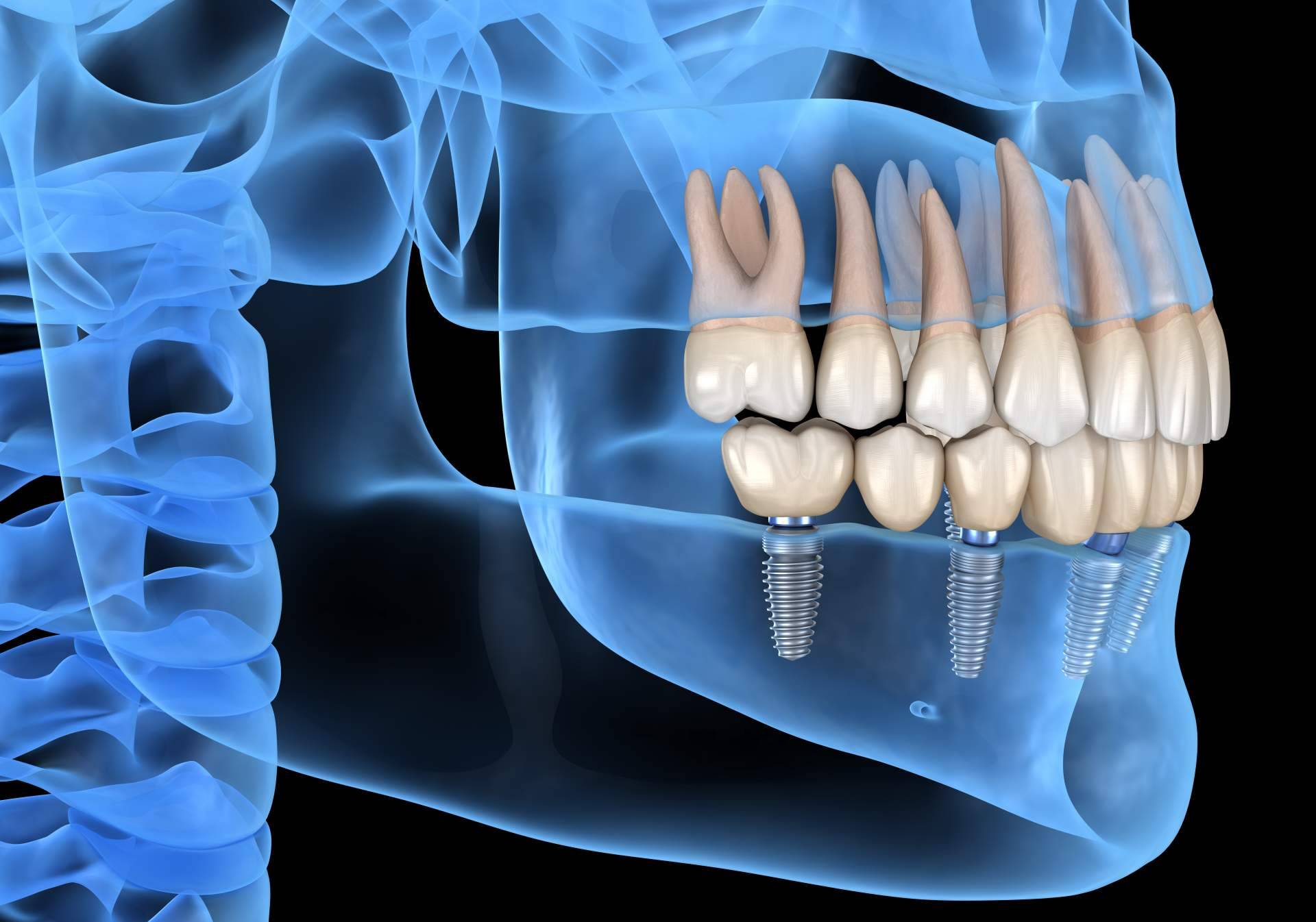 Los implantes dentales que brinda la Clínica Dental de la Doctora Cachero