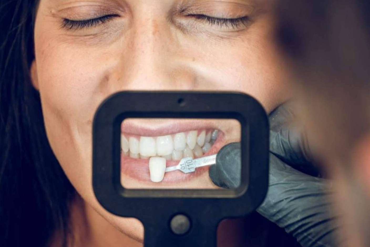 ¿Cuáles son los beneficios de las carillas de composite?, con Clínica Dental Ruiz de Gopegui