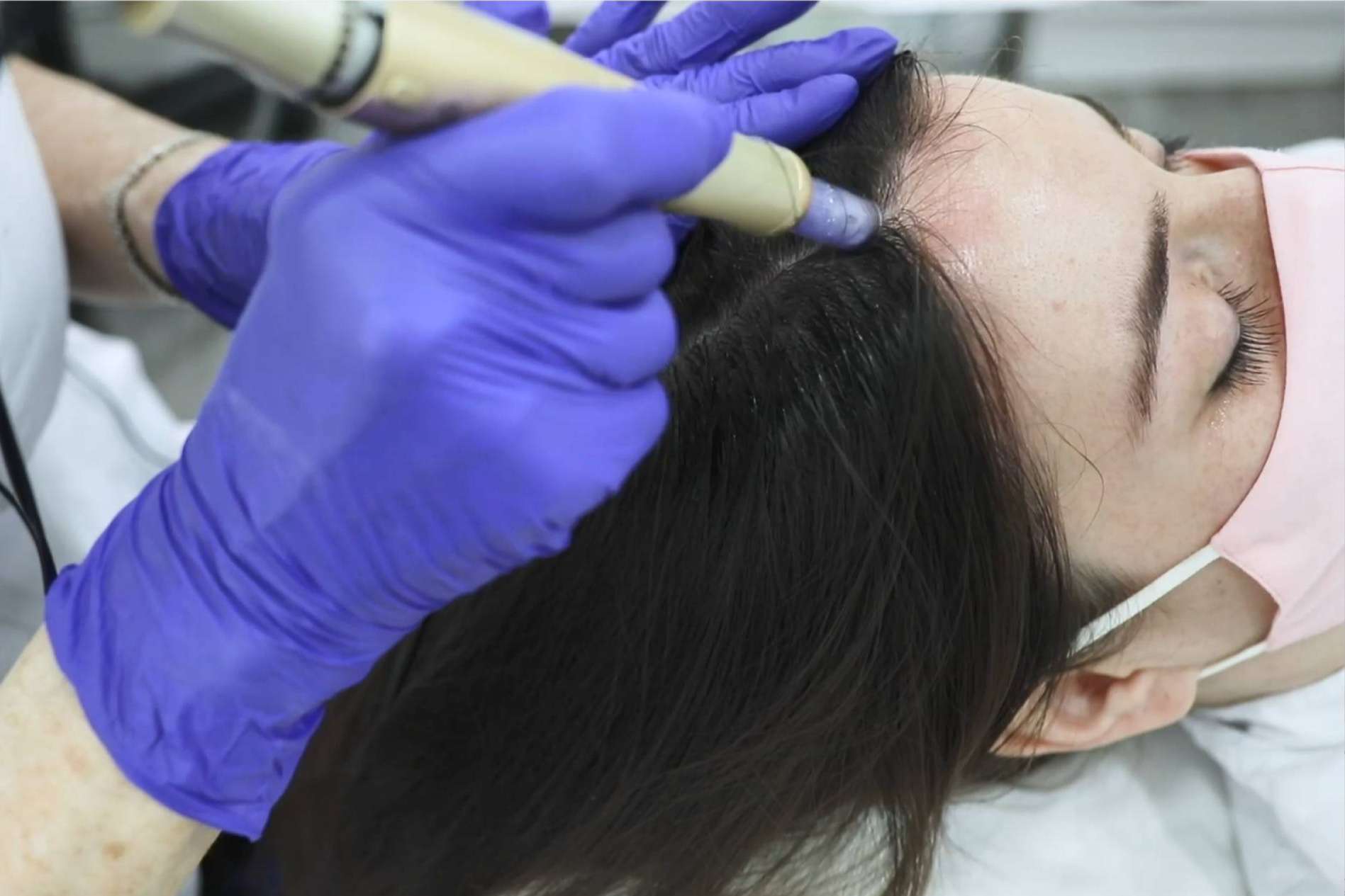 Recuperar el cabello con el efectivo tratamiento de bioestimulación para la alopecia femenina del IMD Instituto Médico Dermatológico