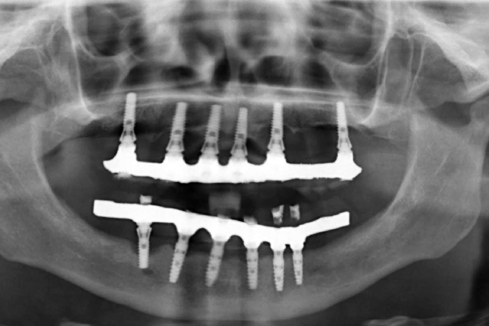 Todo sobre los implantes dentales de la Clínica Calvo de Mora