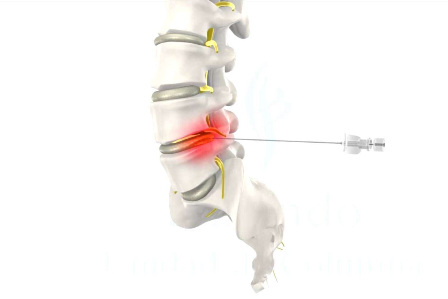 La innovadora cirugía de hernia discal en menos de una hora y sin ingreso hospitalario