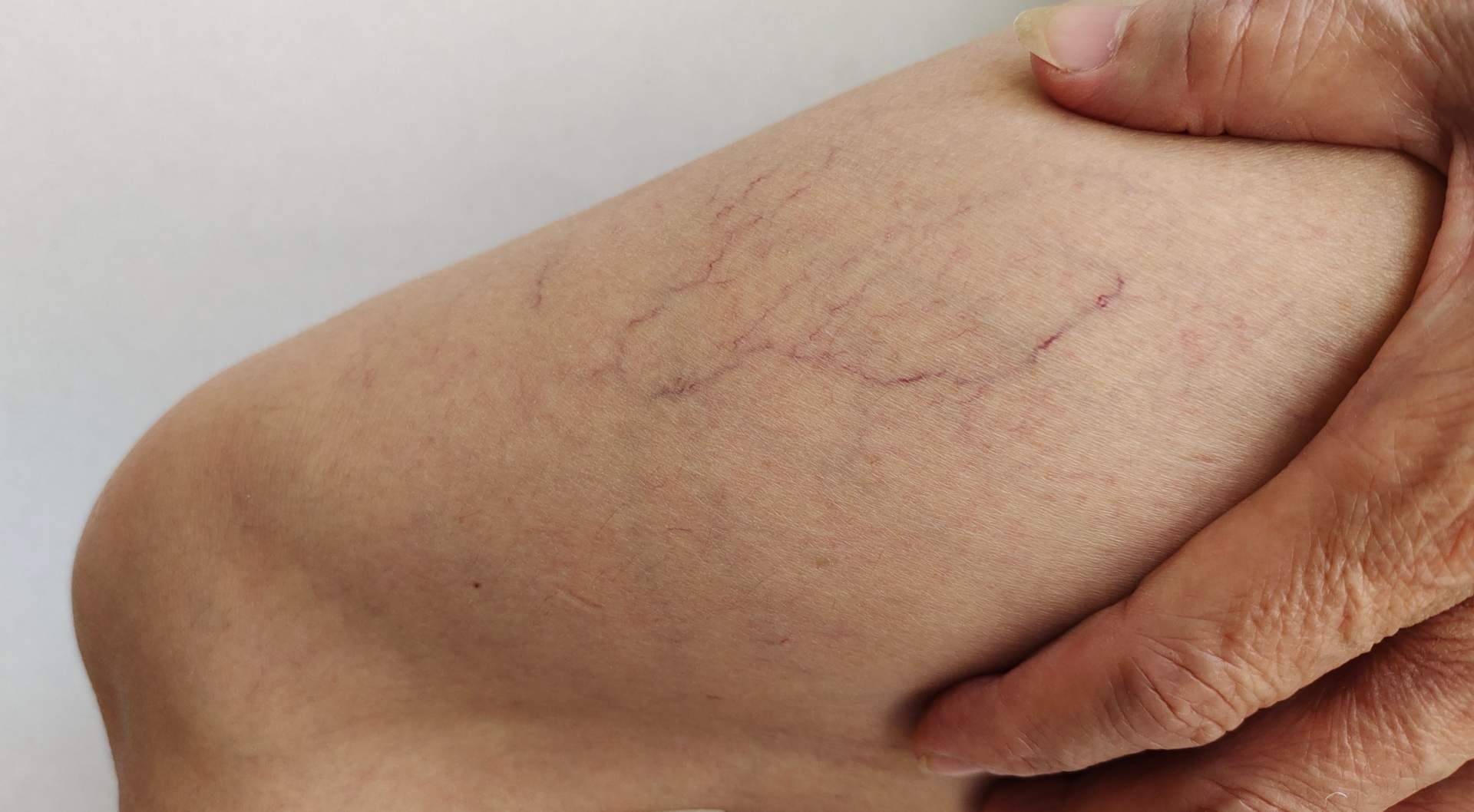 Pesadez de piernas e hinchazón en verano por mala circulación