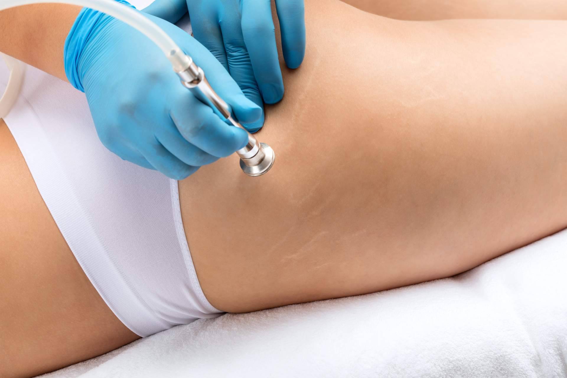 Eliminar estrías en Madrid; experiencia y resultados garantizados en Centro Médico El Pilar