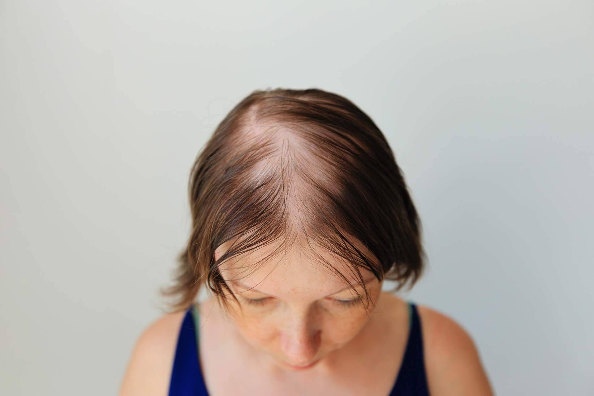 Detectar la alopecia femenina y conocer sus tratamientos adecuados