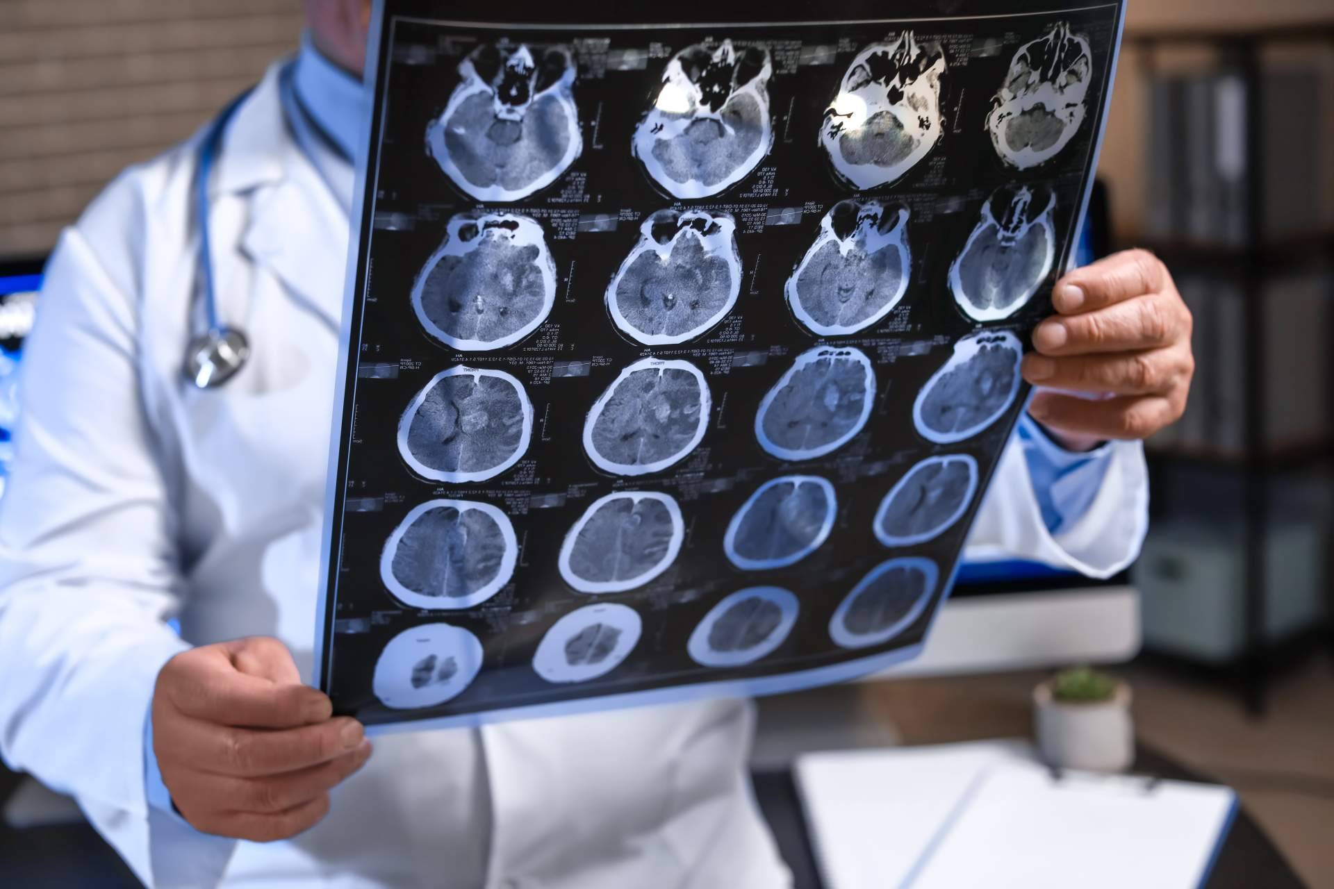 Innovación en Clínica DKF en el tratamiento del Alzheimer en fase temprana