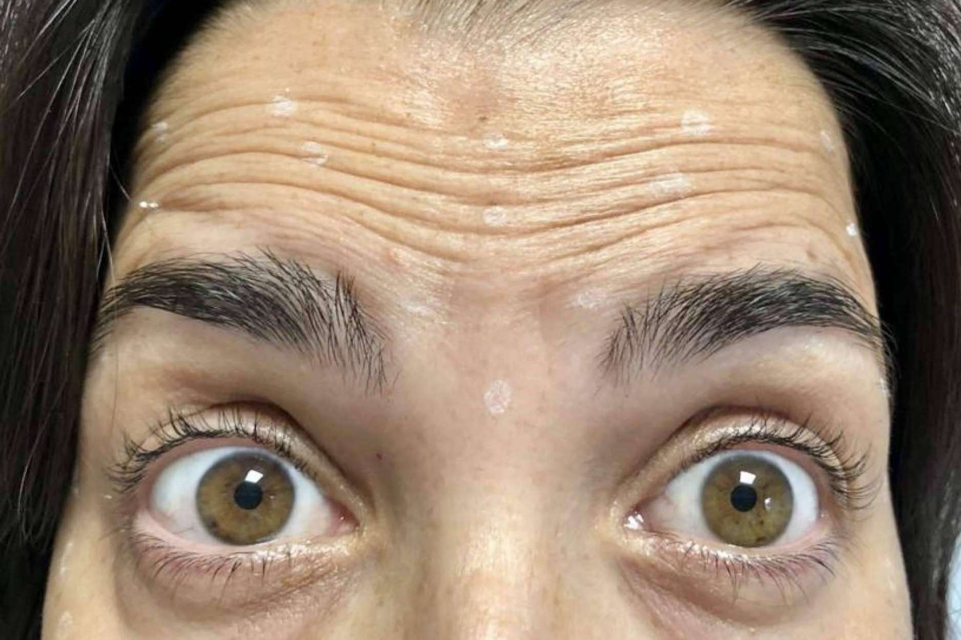 Un aspecto joven y natural con el tratamiento de rejuvenecimiento facial de Clínica Amalfi