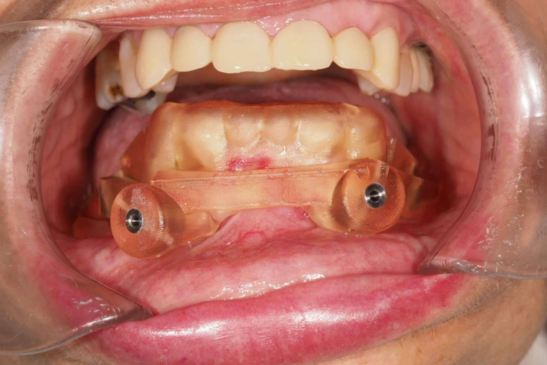 Implantes dentales en el Centro Nacional de Cirugía Bucomaxilofacial e Implantes