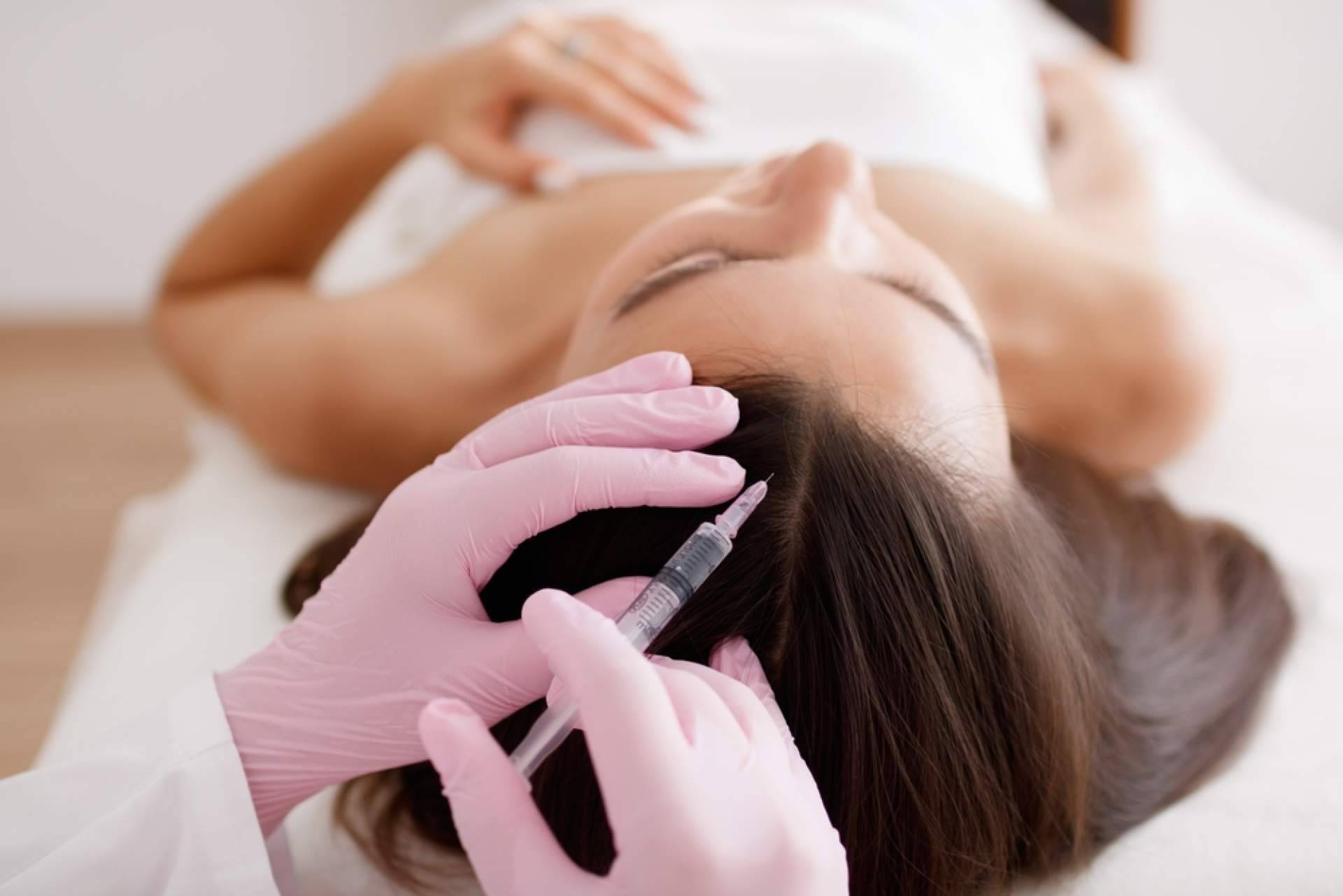 Mesoterapia capilar, la terapia sin cirugía que combate la caída del cabello