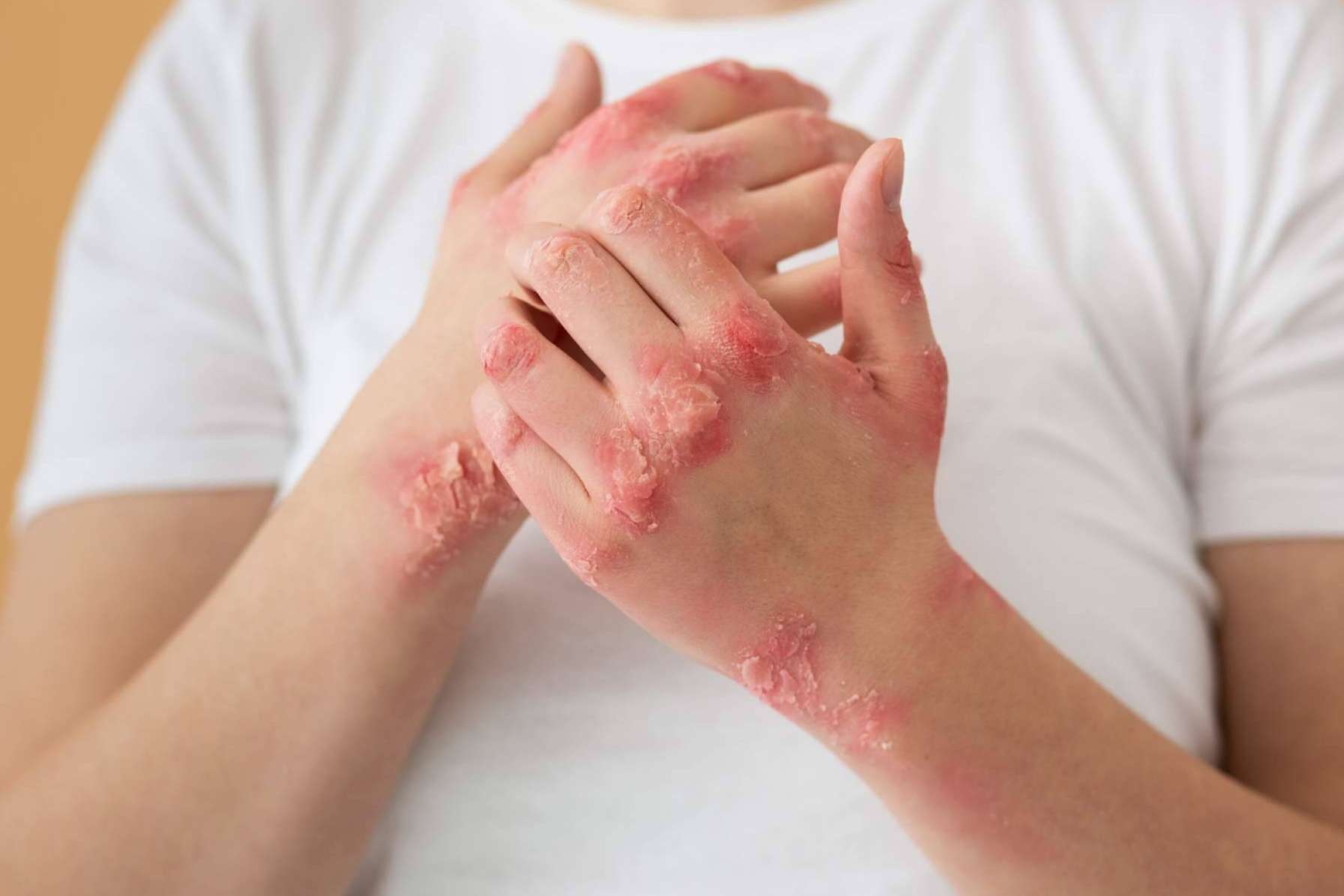 Los luchadores contra el eczema ahora tienen un superhéroe, Novopiel