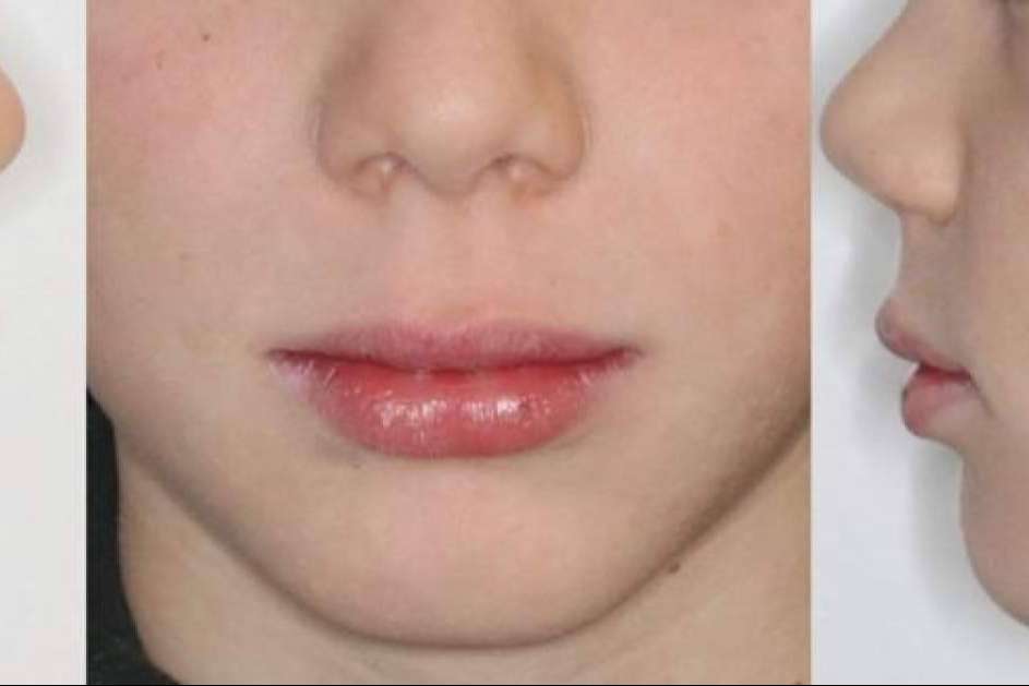 Todo sobre el mentón Fuyant y cómo tratarlo, de la mano de Clínica Zahara