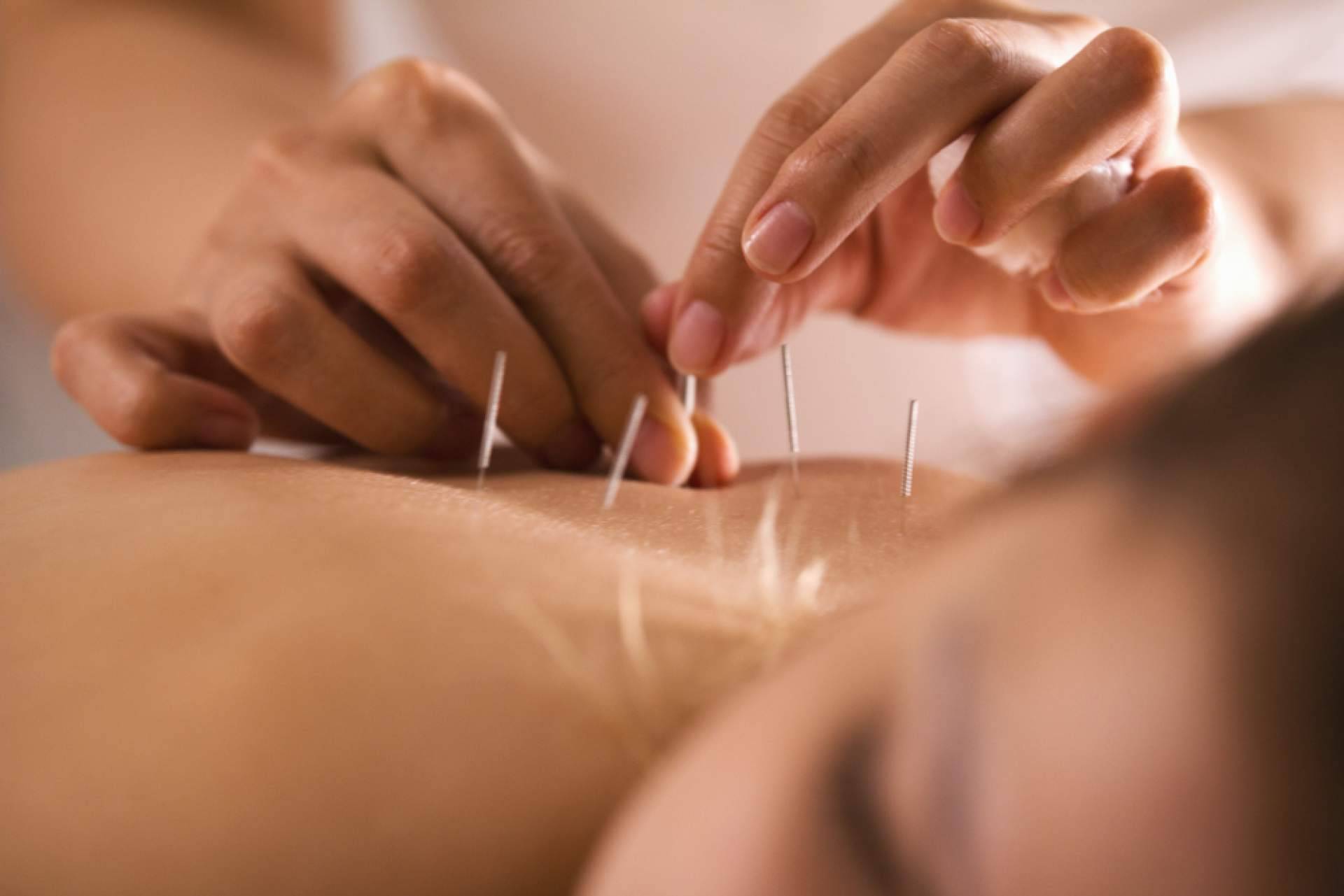 La acupuntura, un buen aliado para casos de ansiedad, insomnio o estrés crónico