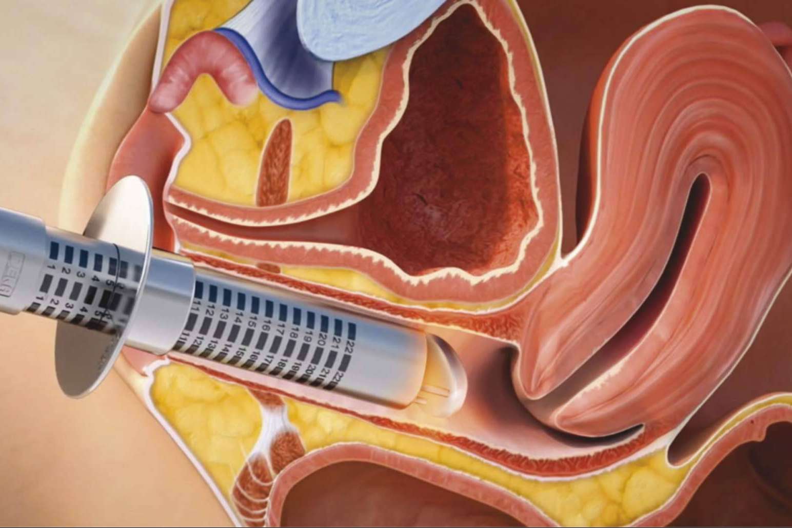 Conocer las secuelas del cáncer de mama… de las que nadie habla
