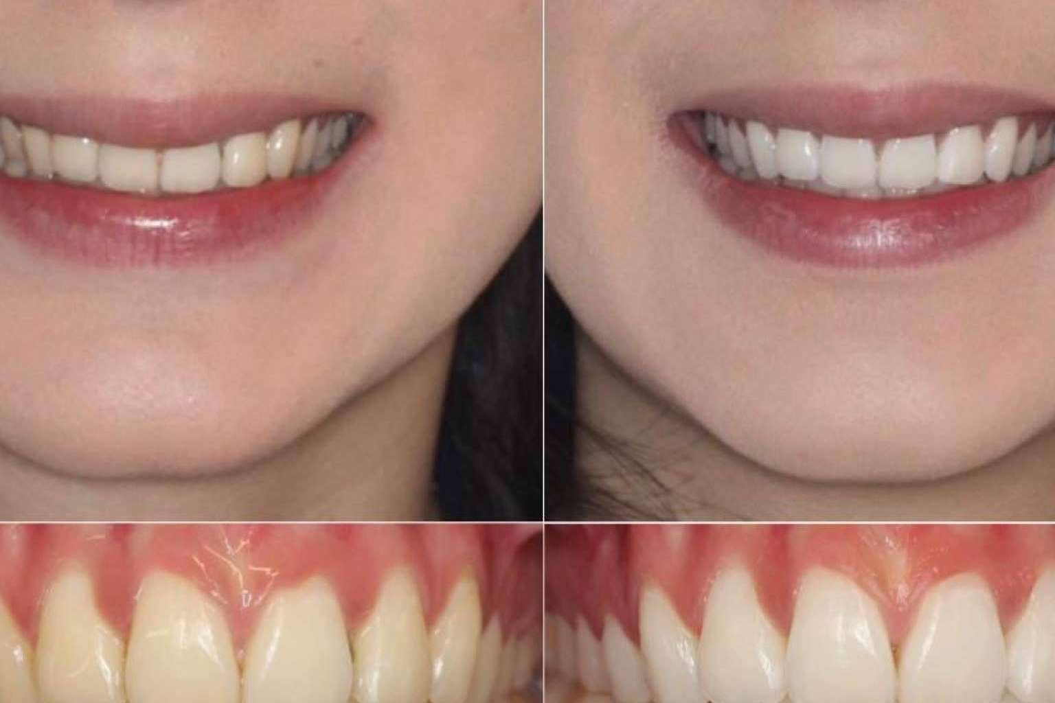 Clínica Zahara y sus servicios de blanqueamientos dentales