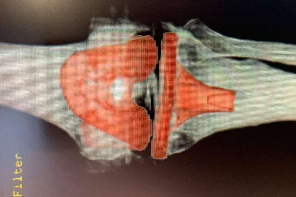 Optar por tratamientos nuevos para la artrosis y retrasar el envejecimiento del cuerpo