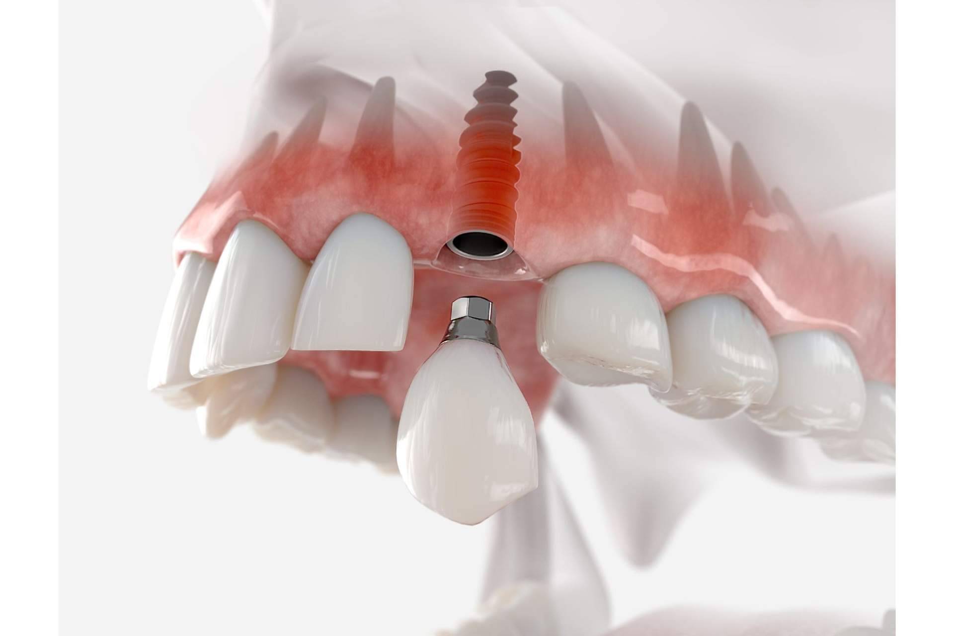 DeltaDent habla sobre los beneficios de un implante dental