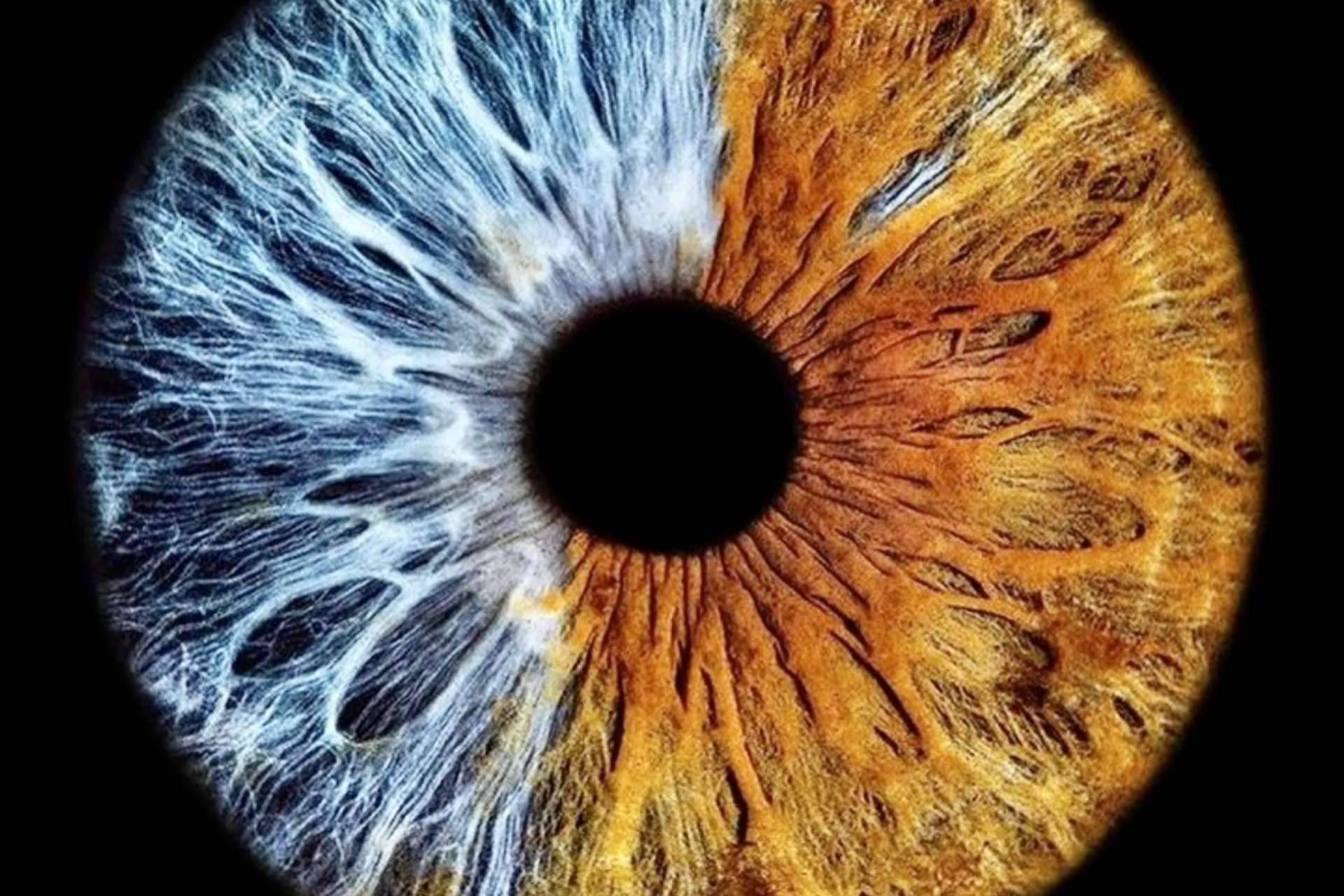 La iridoplastia laser NewEyes no afecta negativamente a la visión