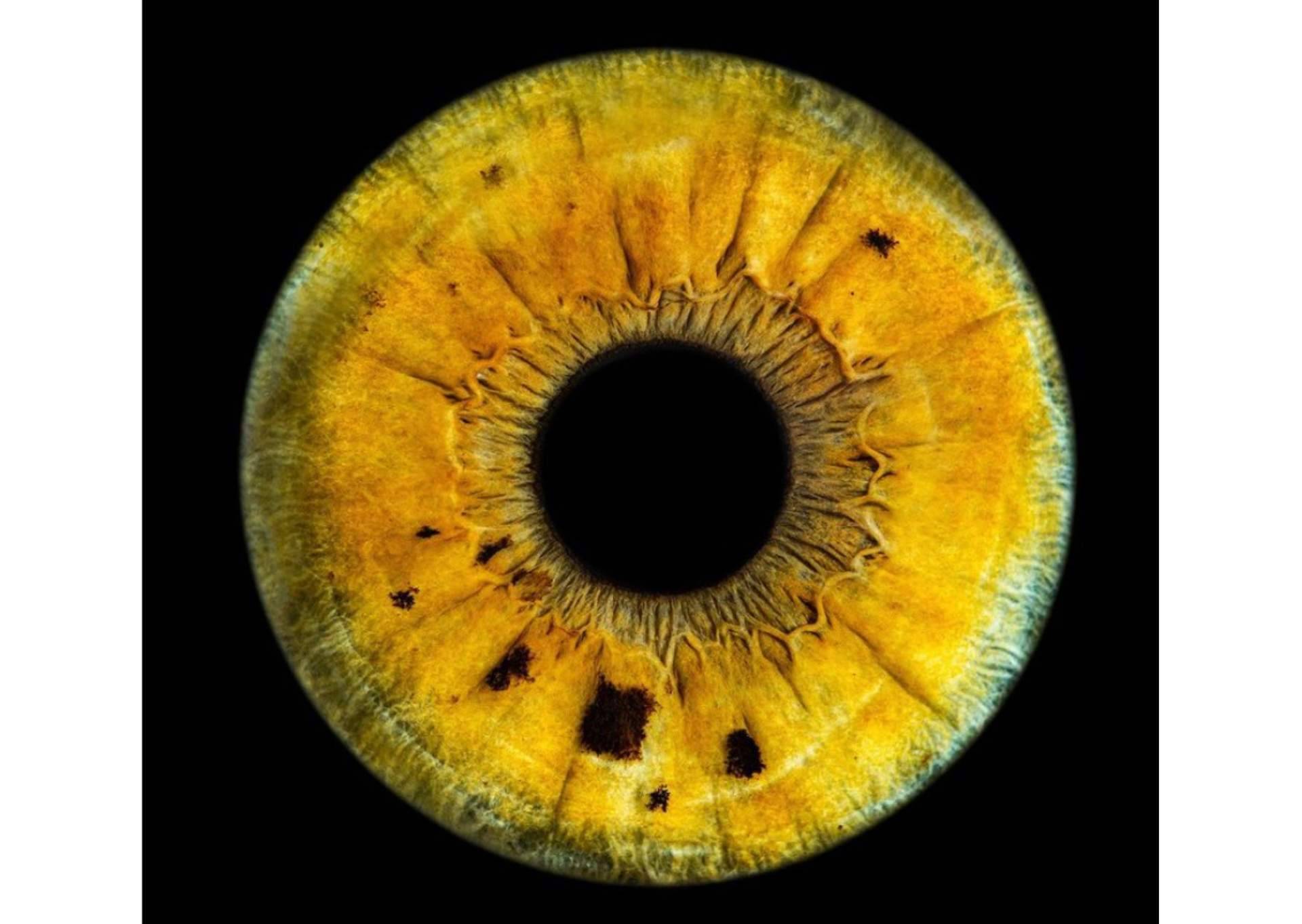 El color de los ojos puede cambiar por enfermedades metabólicas, según una advertencia de la clínica Eyecos