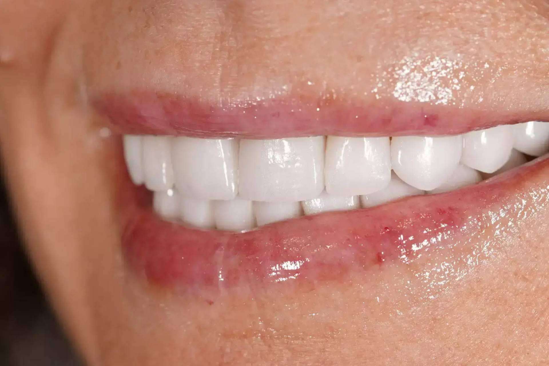 Tratamientos de estética dental en Denty Dent