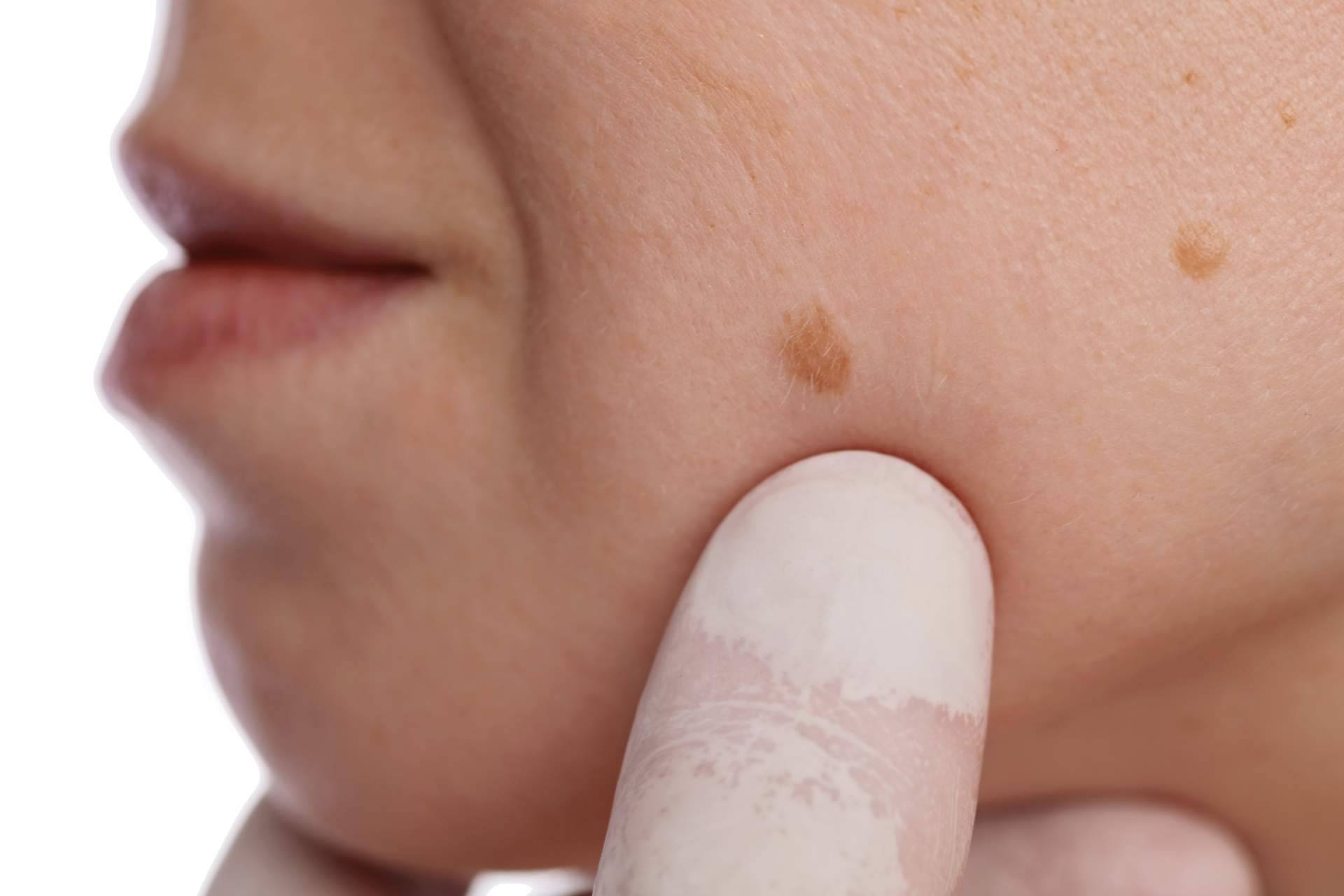 Eliminar manchas en la piel con láser con los servicios de Centro Estética El Pilar
