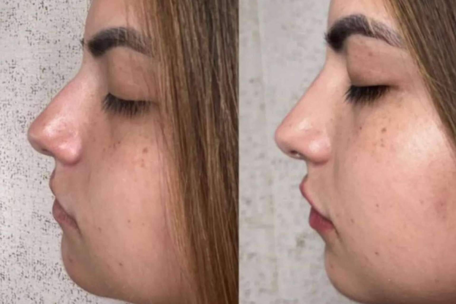 La clínica del Dr. Guidi tiene especialistas en rinomodelación en Málaga