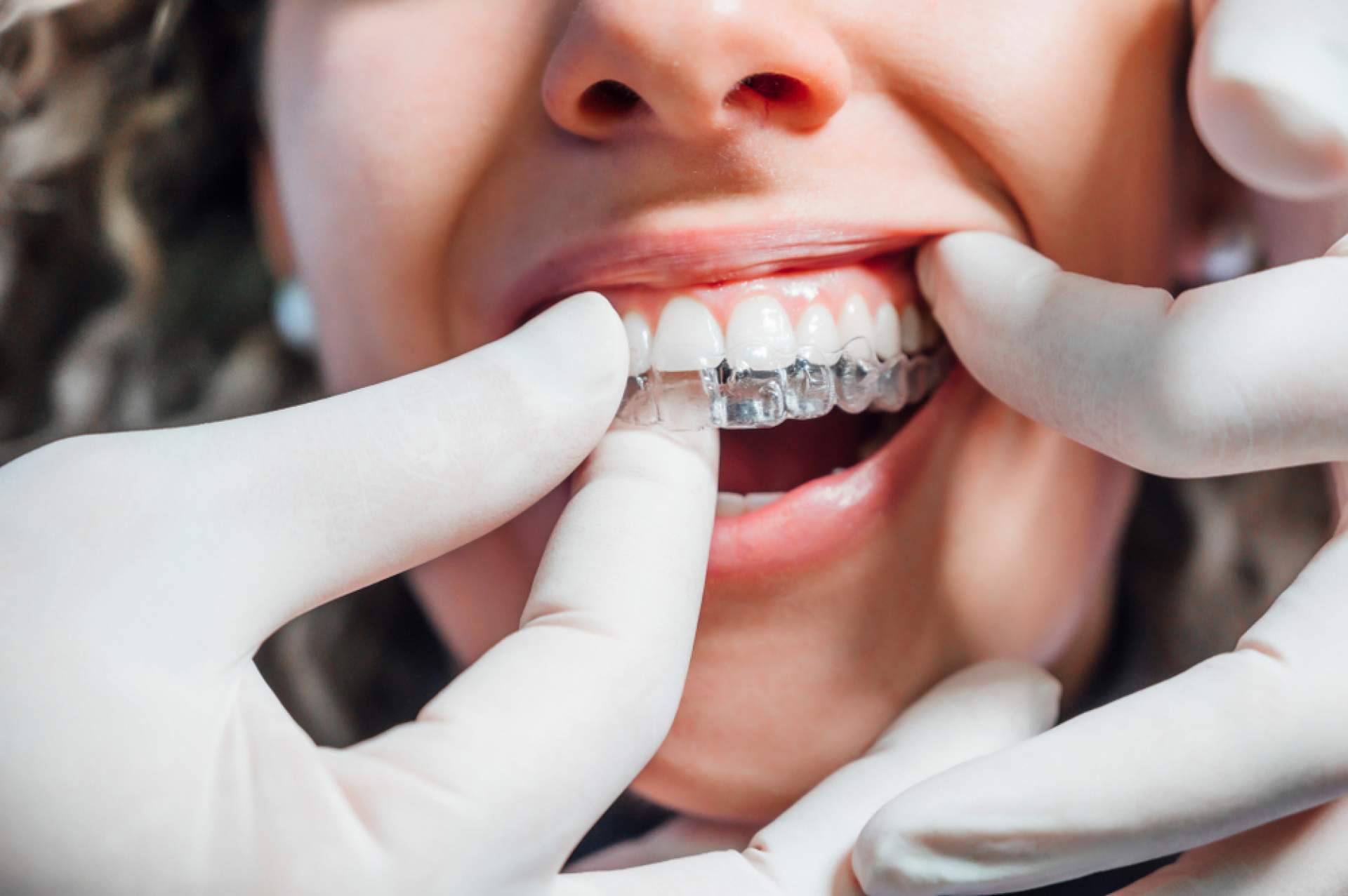 Las ventajas de la ortodoncia Invisalign, por InterORALIA