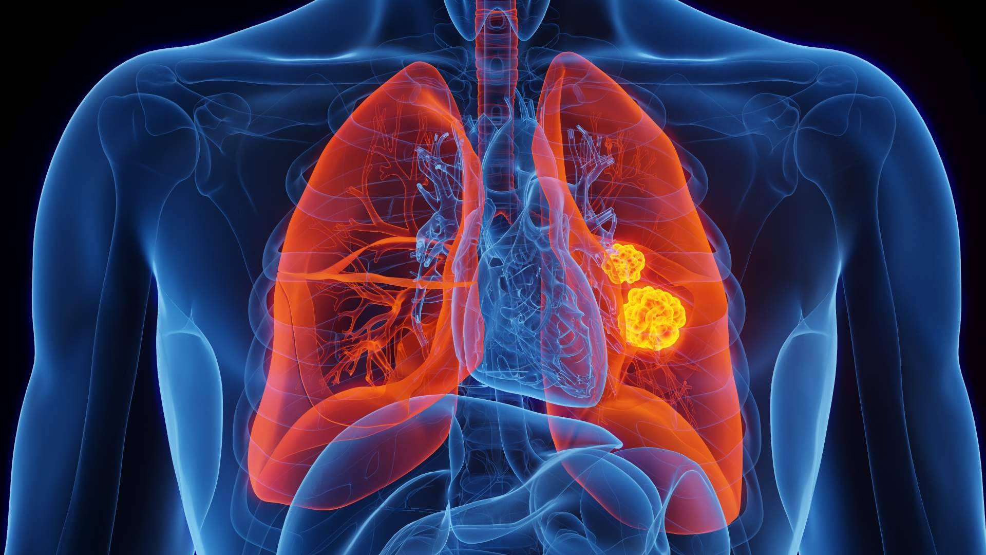 Todo sobre el tratamiento de cáncer de pulmón con Oncothermia (Nanothermia)