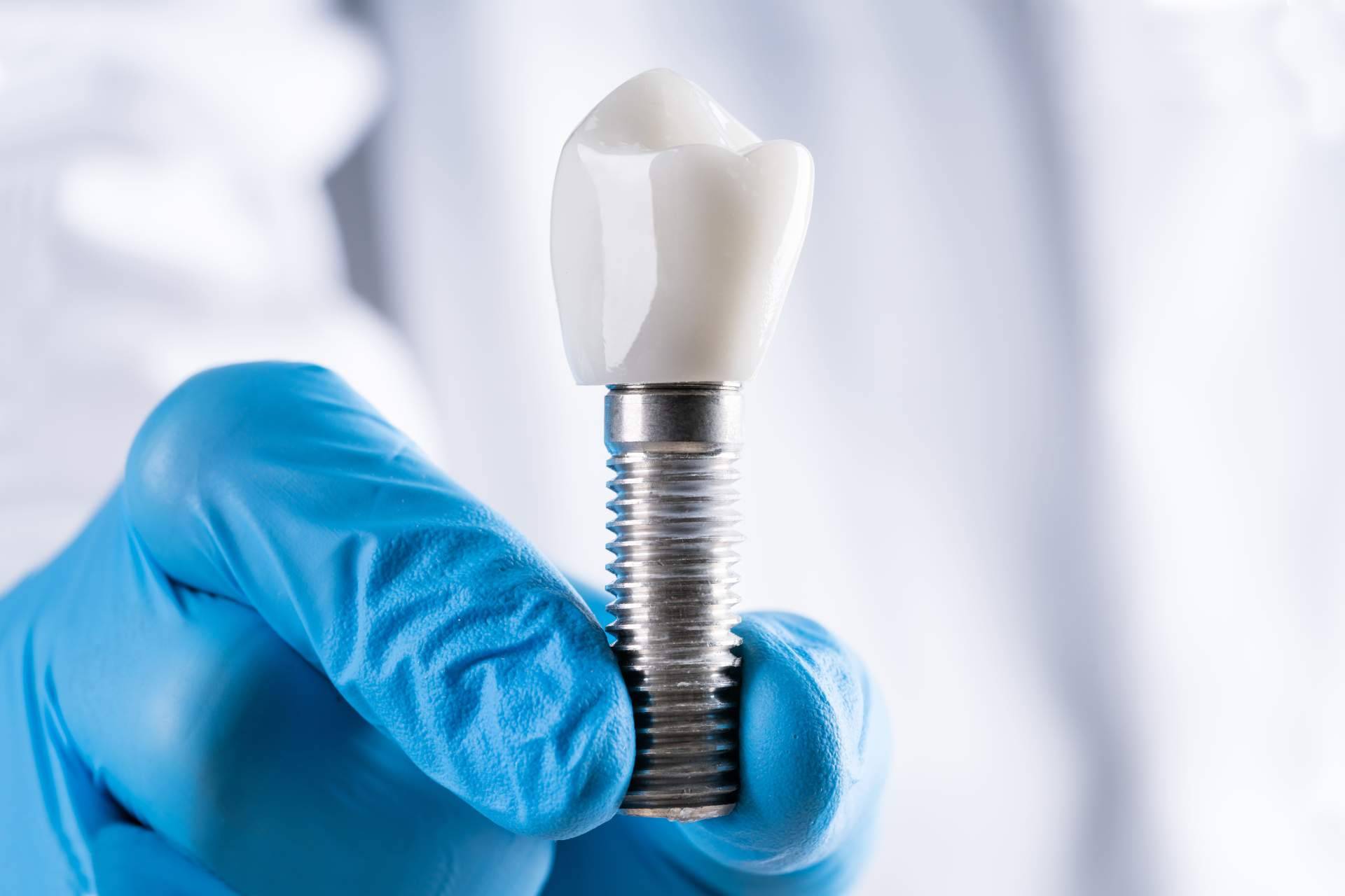 Servicios profesionales de implantología dental en Barcelona de la mano de Clínica Dental Arai