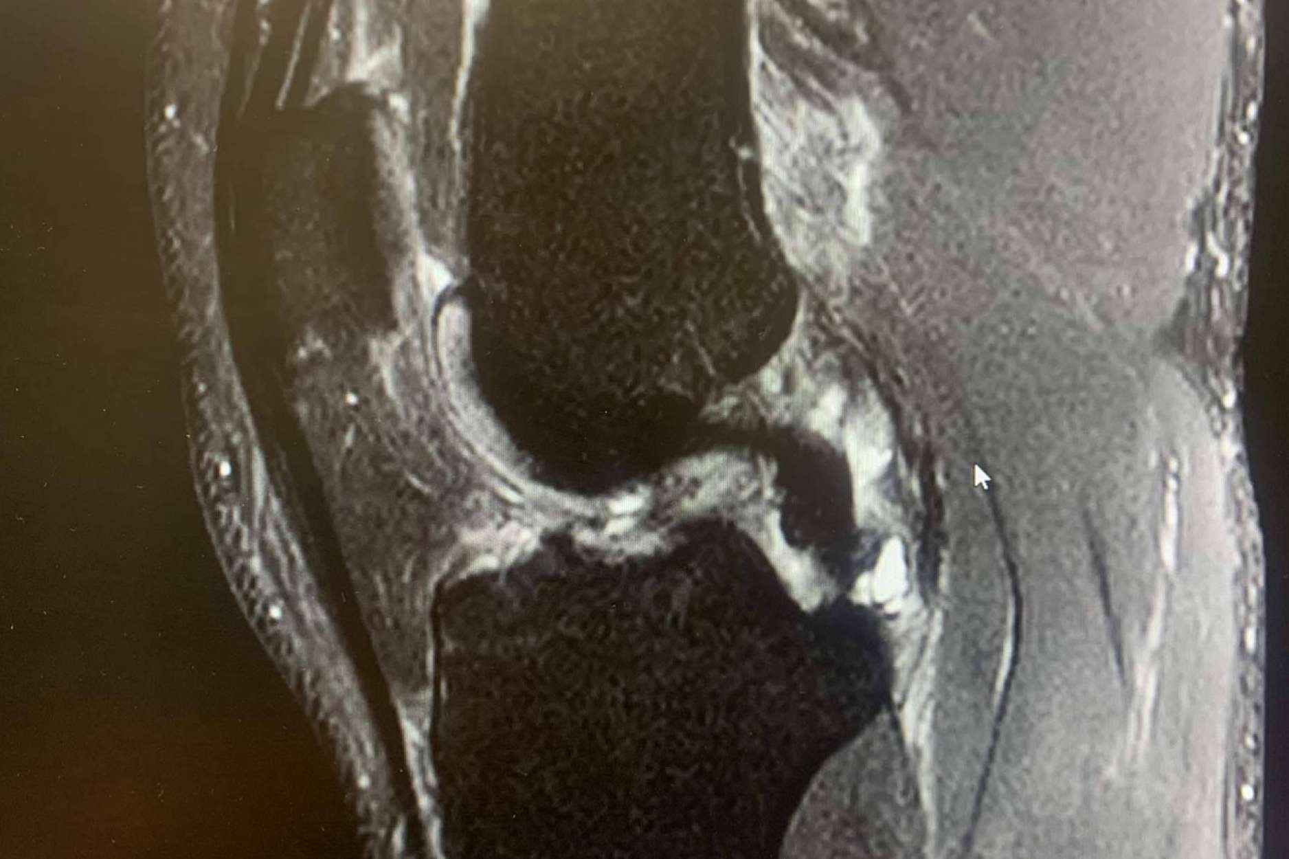 La prevención de las lesiones de ligamento cruzado anterior de la mano de Regeneractiva