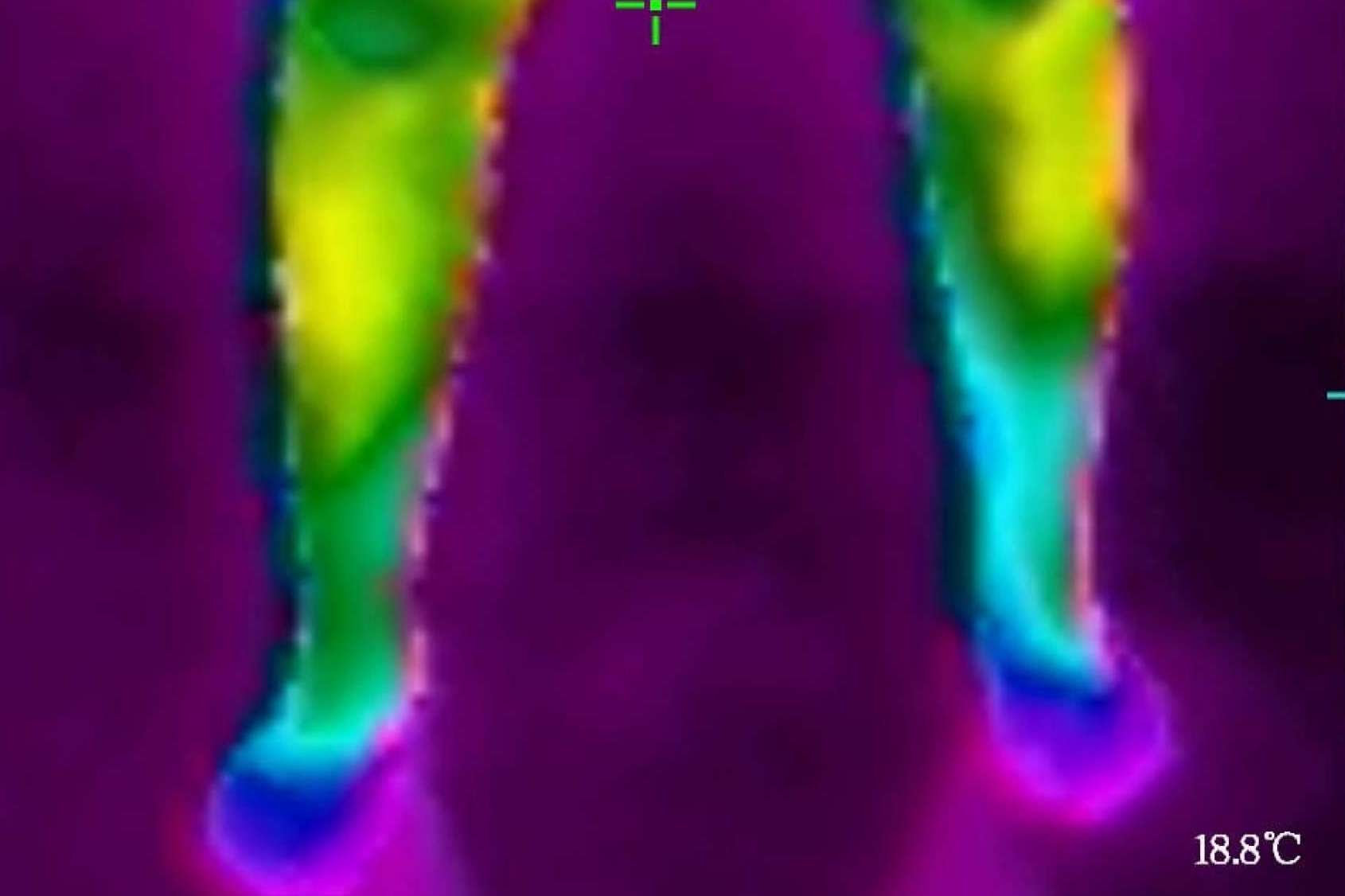 Saber cuál es la tipología de celulitis con la cámara termográfica es posible