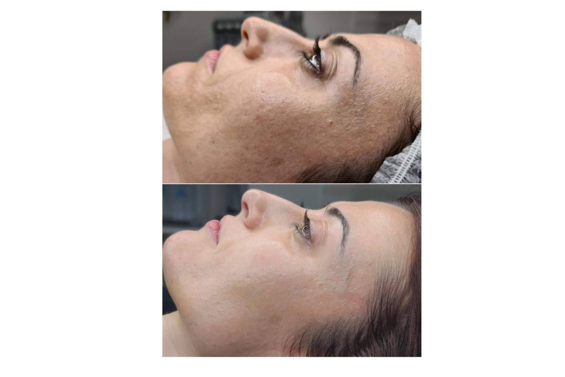 Renovación celular con biomicroneedling; la técnica basada en espículas de esponja en Clinica Marta Solà