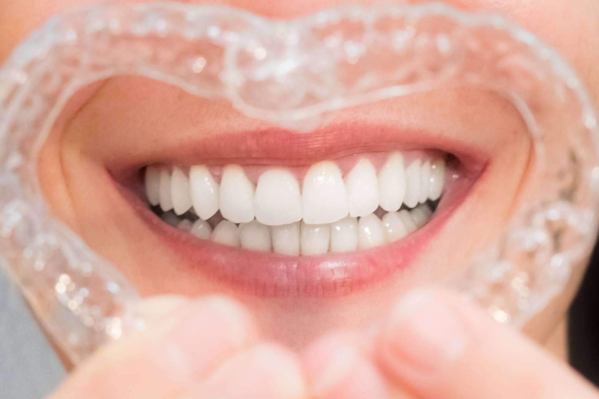 Blanqueamiento dental avanzado con luz LED para conseguir una apariencia radiante